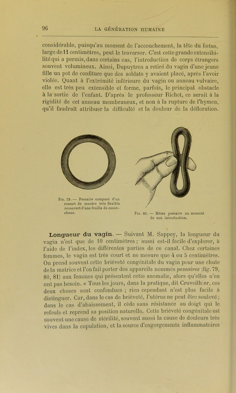 considérable, puisqu’au moment de l’accouchement, la tête du fœtus, large de 11 centimètres, peut le traverser. C’est cette grande extensibi- lité qui a permis, dans certains cas, l’introduction de corps étrangers souvent volumineux. Ainsi, Dupuytren a retiré du vagin d’une jeune fille un pot de confiture que des soldats y avaient placé, après l’avoir violée. Quant à l’extrémité inférieure du vagin ou anneau vulvaire, elle est très peu extensible et forme, parfois, le principal obstacle à la'sortie de l’enfant. D’après le professeur Richet, ce serait à la rigidité de cet anneau membraneux, et non à la rupture de l’hymen, qu’il faudrait attribuer la difficulté et la douleur de la défloration. Longueur du vagin. — Suivant M. Sappey, la longueur du vagin n’est que de 10 centimètres; aussi est-il facile d’explorer, à l’aide de l’index, les différentes parties de ce canal. Chez certaines femmes, le vagin est très court et ne mesure que 4 ou 5 centimètres. On prend souvent cette brièveté congénitale du vagin pour une chute delà matrice et l’on fait porter des appareils nommés pessaiVes (fig. 79, 80, 81) aux femmes qui présentent cette anomalie, alors qu’elles n’en ont pas besoin. « Tous les jours, dans la pratique, dit Cruveilhier, ces deux choses sont confondues ; rien cependant n’est plus facile à distinguer. Car, dans le cas de brièveté, l’utérus ne peut être soulevé ; dans le cas d’abaissement, il cède sans résistance au doigt qui le refoule et reprend sa position naturelle. Cette brièveté congénitale est souvent une cause de stérilité, souvent aussi la cause de douleurs très vives dans la copulation, et la source d engorgements inflammatoires F rûssorl do montre très flexible recouvert d'uQO feuille de caout^ chouc. / Fig. 80. — Mômo peesairo au moment de son introduction.