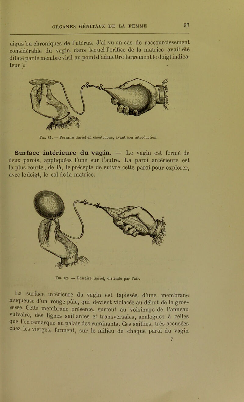 aigus ou chroniques de l’utérus. J’ai vu un cas de raccourcissement considérable du vagin, dans lequel l’orifice de la matrice avait été dilaté par le membre viril au point d’admettre largement le doigt indica- teur.» Fig. 81. — Pessairo Gariel en caoutchouc, avant son introduction. Surface intérieure du vagin. — Le vagin est formé de deux parois, appliquées l’une sur l’autre. La paroi antérieure est la plus courte; de là, le précepte de suivre cette paroi pour explorer, avec le doigt, le col de la matrice. La surface intérieure du vagin est tapissée d’une membrane muqueuse d’un rouge pâle, qui devient violacée au début de la gros- sesse. Cette membrane présente, surtout au voisinage de l’anneau vulvaire, des lignes saillantes et transversales, analogues à celles que 1 on remarque au palais des ruminants. Ces saillies, très accusées chez les vierges, forment, sur le milieu de chaque paroi du vagin 7