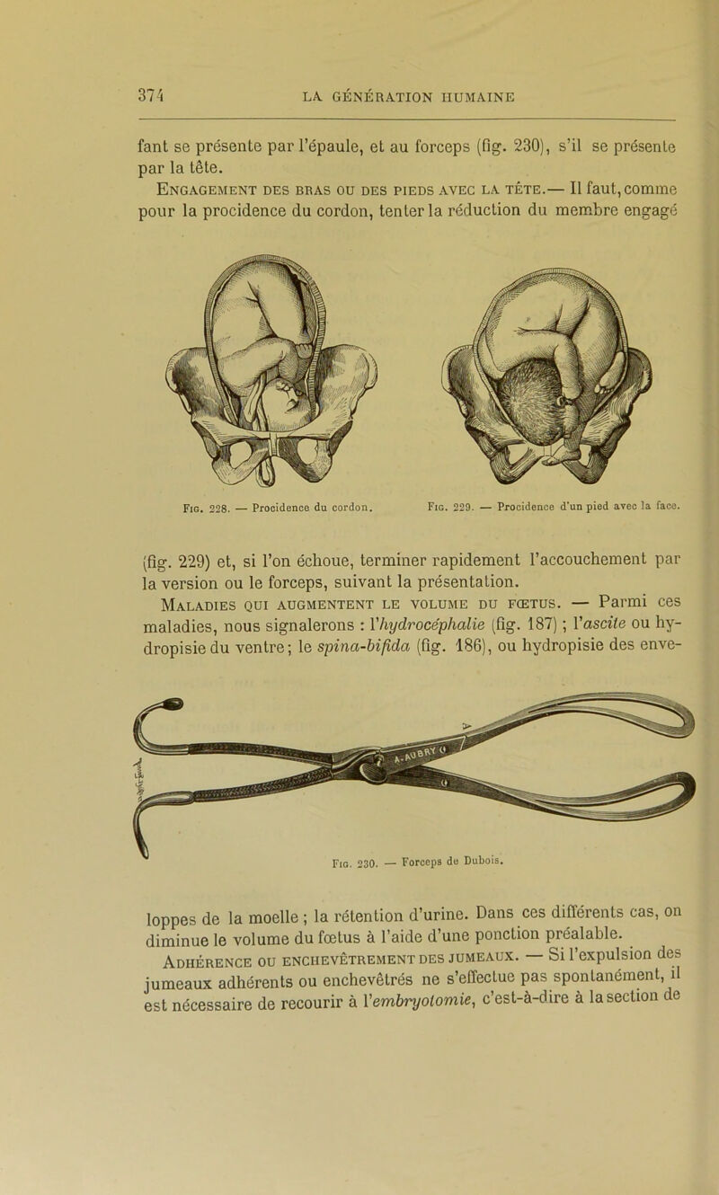 fant se présente par l’épaule, et au forceps (fig. 230), s’il se présente par la tête. Engagement des bras ou des pieds avec la tête.— Il faut, comme pour la procidence du cordon, tenter la réduction du membre engagé Fig. 228. — Procidence du cordon. Fig. 229. — Procidence d’un pied avec la face. (fîg. 229) et, si l’on échoue, terminer rapidement l’accouchement par la version ou le forceps, suivant la présentation. Maladies qui augmentent le volume du fœtus. — Parmi ces maladies, nous signalerons : l'hydrocéphalie (fig. 187) ; l'ascite ou hy- dropisie du ventre; le spina-bifida (fig. 186), ou hydropisie des enve- loppes de la moelle ; la rétention d’urine. Dans ces différents cas, on diminue le volume du fœtus à l’aide d’une ponction préalable. Adhérence ou enchevêtrement des jumeaux. — Si l’expulsion des jumeaux adhérents ou enchevêtrés ne s’effectue pas spontanément, il est nécessaire de recourir à l'embryotomie, c’est-à-dire à la section de