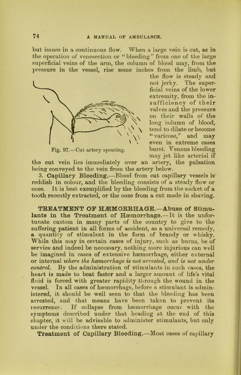 but issues in a continuous flow. When a large vein is cut, as in the operation of venesection or “ bleeding ” from one of the large superficial veins of the arm, the column of blood may, from the pressure in the vessel, rise some inches from the limb, but the flow is steady and not jerky. The super- ficial veins of the lower extremity, from the in- sufficiency of their valves and the pressure on their walls of the long column of blood, tend to dilate or become “ varicose,” and may even in extreme cases burst. Venous bleeding may jet like arterial if the cut vein lies immediately over an artery, the pulsation being conveyed to the vein from the artery below. 3. Capillary Bleeding.—Blood from cut capillary vessels is reddish in colour, and the bleeding consists of a steady flow or ooze. It is best exemplified by the bleeding from the socket of a tooth recently extracted, or the ooze from a cut made in shaving. TREATMENT OP HEMORRHAGE.—Abuse of Stimu- lants in the Treatment of Haemorrhage.—It is the unfor- tunate custom in many parts of the country to give to the suffering patient in all forms of accident, as a universal remedy, a quantity of stimulant in the form of brandy or whisky. While this may in certain cases of injury, such as burns, be of service and indeed be necessary, nothing more injurious can well be imagined in cases of extensive haemorrhage, either external or internal where the hcemorrhage is not arrested^ and is not under control. By the administration of stimulants in such cases, the heart is made to beat faster and a larger amount of life’s vital fluid is forced with greater rapidity through the wound in the vessel. In all cases of haemorrhage, before a stimulant is admin- ; istered, it should be well seen to that the bleeding has been arrested, and that means have been taken to prevent its recurrence. If collapse from haemorrhage occur with the symptoms described under that heading at the end of this chapter, it will be advisable to administer stimulants, but only under the conditions there stated. Treatment of Capillary Bleeding.—Most cases of capillary | \ i 1