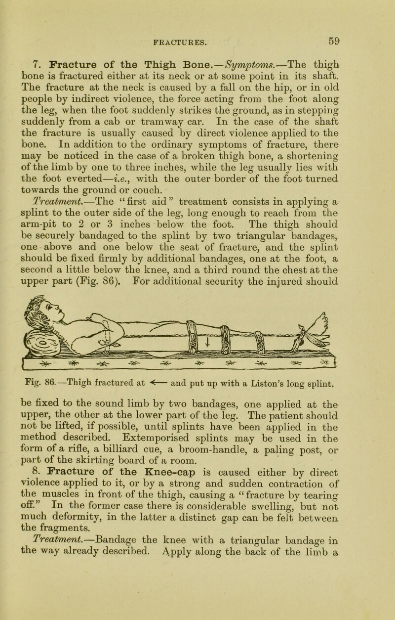 7. Fracture of the Thigh Bone.—Symptoms.—The thigh bone is fractured either at its neck or at some point in its shaft. The fracture at the neck is caused by a fall on the hip, or in old people by indirect violence, the force acting from the foot along the leg, when the foot suddenly strikes the ground, as in stepping suddenly from a cab or tramway car. In the case of the shaft the fracture is usually caused by direct violence applied to the bone. In addition to the ordinary symptoms of fracture, there may be noticed in the case of a broken thigh bone, a shortening of the limb by one to three inches, while the leg usually lies with the foot everted—i.e., with the outer border of the foot turned towards the ground or couch. Treatment.—The “ first aid ” treatment consists in applying a splint to the outer side of the leg, long enough to reach from the arm-pit to 2 or 3 inches below the foot. The thigh should be securely bandaged to the splint by two triangular bandages, one above and one below the seat of fracture, and the splint should be fixed firmly by additional bandages, one at the foot, a second a little below the knee, and a third round the chest at the upper part (Fig. 86). For additional security the injured should Fig. 86. —Thigh fractured at <— and put up with a Liston’s long splint. be fixed to the sound limb by two bandages, one applied at the upper, the other at the lower part of the leg. The patient should not be lifted, if possible, until splints have been applied in the method described. Extemporised splints may be used in the form of a rifle, a billiard cue, a broom-handle, a paling post, or part of the skirting board of a room. 8. Fracture of the Knee-cap is caused either by direct violence applied to it, or by a strong and sudden contraction of the muscles in front of the thigh, causing a “ fracture by tearing ofi*.” In the former case there is considerable swelling, but not much deformity, in the latter a distinct gap can be felt between the fragments. Treatment.—Bandage the knee with a triangular bandage in the way already described. Apply along the back of the limb a