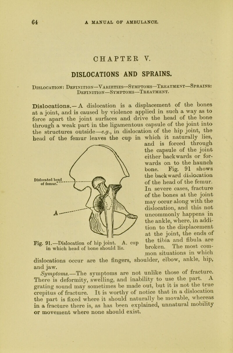 CHAPTER V. DISLOCATIONS AND SPRAINS. Dislocation: Definition—Varieties—Symptoms—Treatment—Sprains: Definition—Symptoms—Treatment. Dislocations.—A dislocation is a displacement of the bones at a joint, and is caused by violence applied in such a way as to force apart the joint surfaces and drive the head of the bone through a weak part in the ligamentous capsule of the joint into the structures outside—e.g., in dislocation of the hip joint, the head of the femur leaves the cup in which it naturally lies, and is forced through the capsule of the joiuk either backwards or for- wards on to the haunch bone. Fig. 91 shows the backward dislocation of the head of the femur. In severe cases, fracture of the bones at the joint may occur along with the dislocation, and this not uncommonly happens in the ankle, where, in addi- tion to the displacement at the joint, the ends of the tibia and fibula are broken. The most com- mon situations in which dislocations occur are the fingers, shoulder, elbow, ankle, hip, and jaw. Symptoms.—The symptoms are not unlike those of fracture. There is deformity, swelling, and inability to use the part. A grating sound may sometimes be made out, but it is not the true crepitus of fracture. It is worthy of notice that in a dislocation the part is fixed where it should naturally be movable, whereas in a fracture there is, as has been explained, unnatural mobility or movement where none should exist. Fig. 91.—Dislocation of hip joint. A, cup in which head of bone should lie.