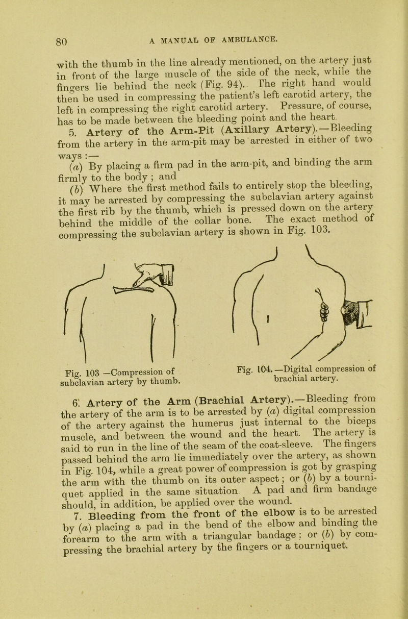 with the thumb in the line already mentioned, on the artery just in front of the large muscle of the side of the neck, while the fincrers lie behind the neck (Fig. 94). The right hand would th^n be used in compressing the patient’s left carotid artery, the left in compressing the right carotid artery. Pressure, of course, has to be made between the bleeding point and the heart 5. Artery of the Arm-Pit (Axillary Artery).—Bleeding from the artery in the arm-pit may be arrested in either of two ^'%) By placing a firm pad in the arm-pit, and binding the arm firmly to the body ; and _ i r (b) Where the first method fails to entirely stop the bleeding, it may be arrested by compressing the subclavian artery against the first rib by the thumb, which is pressed down on the artery behind the middle of the collar bone. The exact method of compressing the subclavian artery is shown in Fig. 6' Artery of the Arm (Brachial Artery).—Bleeding from the artery of the arm is to be arrested by (a) digital compression of the artery against the humerus just internal to the biceps muscle, and between the wound and the heart. The aitery is said to run in the line of the seam of the coat-sleeve. The fingers passed behind the arm lie immediately over the artery, as shown in Fig. 104, while a great power of compression is got by grasping the arm with the thumb on its outer aspect; or (6) by a tourni- quet applied in the same situation. A pad and firm bandage should, in addition, be applied over the wound. 7. Bleeding from the front of the elbow is to be arrested by («) placing a pad in the bend of the elbow and binding the forearm to the arm with a triangular bandage ; or (6) by com- pressing the brachial artery by the fingers or a tourniquet. Fig. 103 —Compression of subclavian artery by thumb. Fig. 104. —Digital compression of brachial artery.