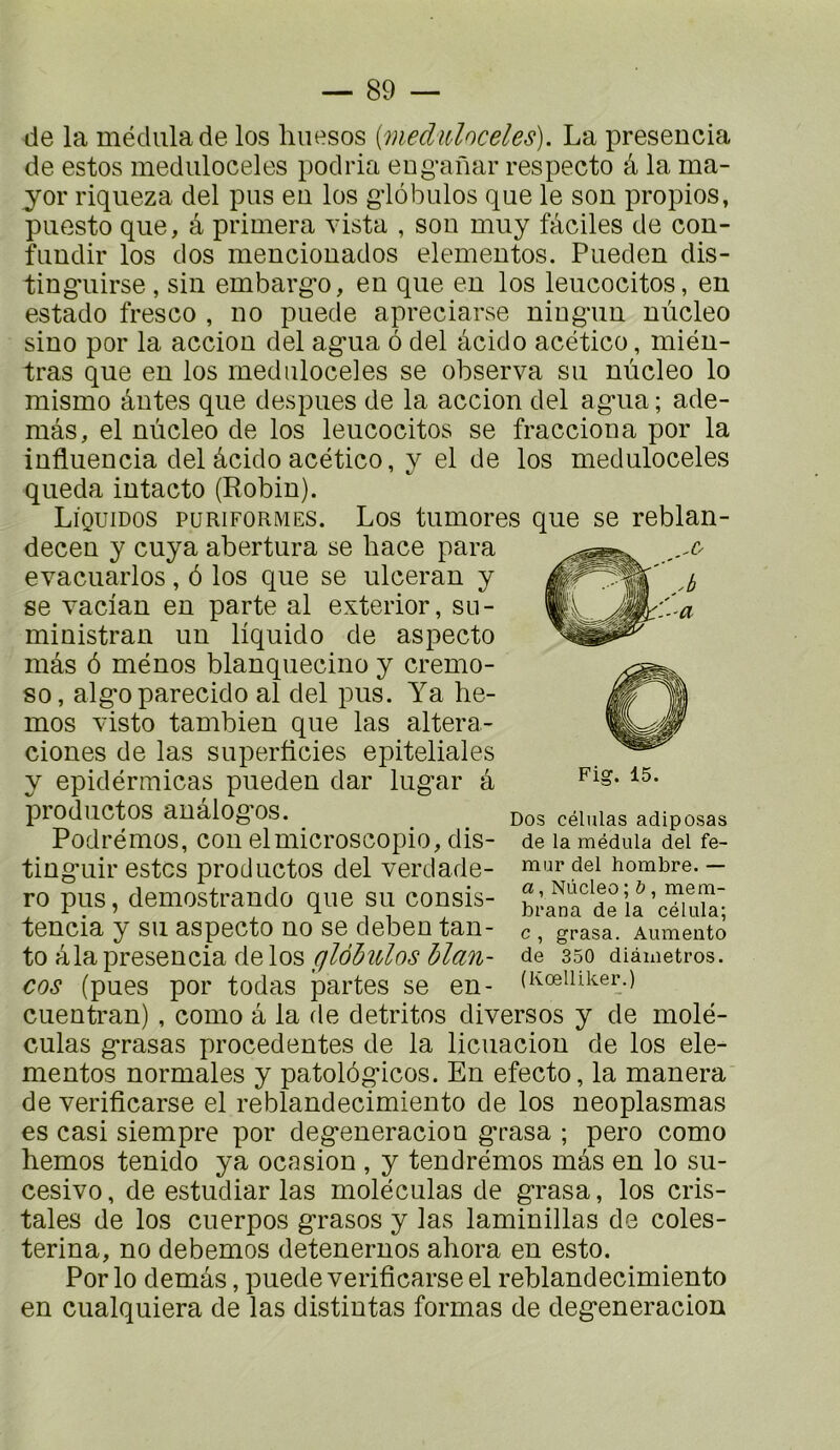 de la médiüade los liuesos {meduloceles). La presencia de estes meduloceles poclria eng-anar respecte â la ma- jor riqueza del pus eu los giôbulos que le sou propios, piicsto que, â primera vista , sou muy faciles de cou- ûmclir los dos meuciouados elemeutos. Puedeu dis- tiug'uirse , siu embarg’o, eu que eu los leucocitos, en estado fresco , uo puede apreciarse uingmu uùcleo siuo por la acciou del agua ô del âcido acético, miéu- tras que eu los meduloceles se observa su uùcleo lo mismo âutes que despues de la acciou del agua; ade- mâs, el uùcleo de los leucocitos se fraccioua por la iuflueucia del âcido acético, y el de los meduloceles queda iutacto (Robiu). Liquidos puriformes. Los tumores que se reblau- deceu y cuya abertura se bace para evacuarlos, 6 los que se ulcerau y se vaciau eu parte al exterior, su- miuistrau uu liquide de aspecto mas 6 méuos blauqueciuo y cremo- so, algoparecido al del pus. Ya he- mos visto tambieu que las altera- cioues de las superficies epiteliales y epidérmicas puedeu dar lugar à productos auâlogos. Podrémos, cou elmicroscopio, dis- tiuguir estes productos del verdade- ro pus, demostraudo que su cousis- teucia y su aspecto uo se debeu tau- to âlapreseucia de los glôhulos hlan- cos (pues por todas partes se eu- cueutrau), como à la de detritos diverses y de molé- culas grasas procedeutes de la licuaciou de los ele- meutos uormales y patolôgicos. Eu efecto, la mauera de verificarse el reblaudecimieuto de los ueoplasmas es casi siempre por degeueraciou grasa ; pero como hemos teuido ya ocasiou , y teudrémos mas eu lo su- cesivo, de estudiar las moléculas de grasa, los cris- taies de los cnerpos grasos y las lamiuillas de coles- teriua, uo debemos deteueruos ahora eu este. Por lo demâs, puede verificarse el reblaudecimieuto eu cualquiera de las distiutas formas de degeueraciou Fig. 15. Dos células adiposas de la médula del fé- mur del hombre. — a, Nücleo ; b, mem- brana de la célula; c , grasa. Aumento de 350 diâmetros. (Kœlliker.)