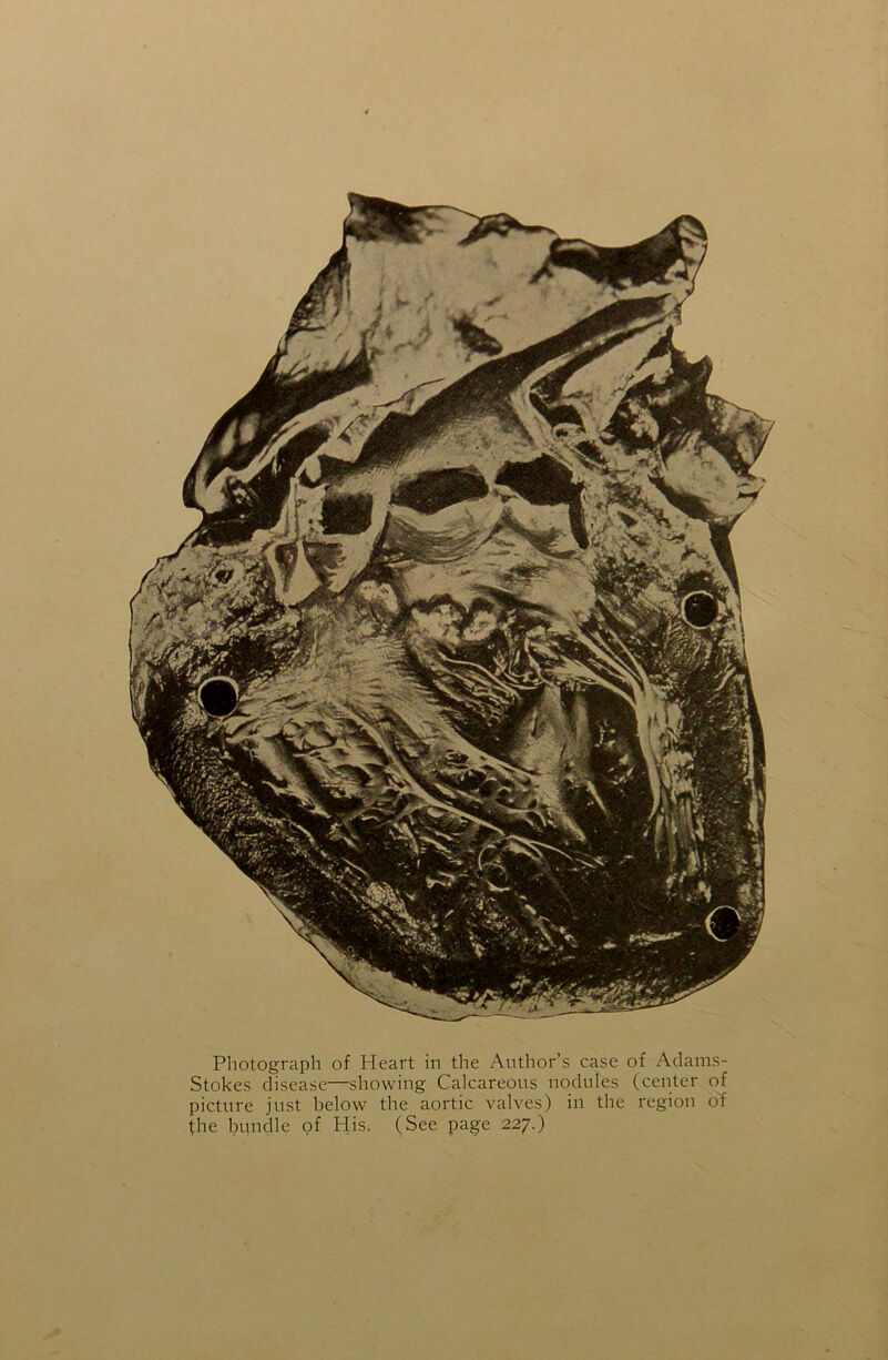 Photograph of Heart in the Author’s case of Adams- Stokes disease—showing Calcareous nodules (center of picture just below the aortic valves) in the region of (he bundle of His. (See page 227.)