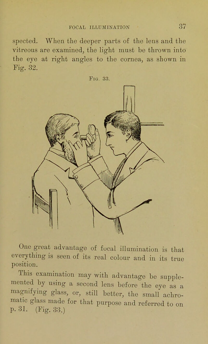 spected. When the deeper parts of the lens and the vitreous are examined, the light must be thrown into the eye at right angles to the cornea, as shown in Fig. 32. Fia. 33. One great advantage of focal illumination is that everything is seen of its real colour and in its true position. Ihis examination may with advantage be supple- mented by using a second lens before the eye as a magnifying glass, or, still better, the small achro- matic glass made for that purpose and referred to on p. 31. (Fig. 33.)