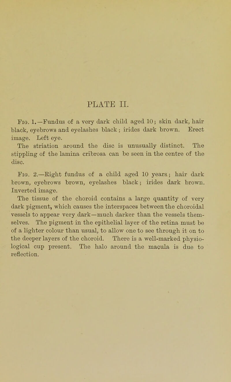 Fig. 1.—Funclus of a very dark child aged 10; skin dark, hair black, eyebrows and eyelashes black ; irides dark brown. Erect image. Left eye. The striation around the disc is unusually distinct. The stippling of the lamina cribrosa can be seen in the centre of the disc. Fig. 2.—Eight fundus of a child aged 10 years; hair dark brown, eyebrows brown, eyelashes black; irides dark brown. Inverted image. The tissue of the choroid contains a large quantity of very dark pigment, which causes the interspaces between the choroidal vessels to appear very dark—much darker than the vessels them- selves. The pigment in the epithelial layer of the retina must be of a lighter colour than usual, to allow one to see through it on to the deeper layers of the choroid. There is a well-marked physio- logical cup present. The halo around the macula is due to reflection.