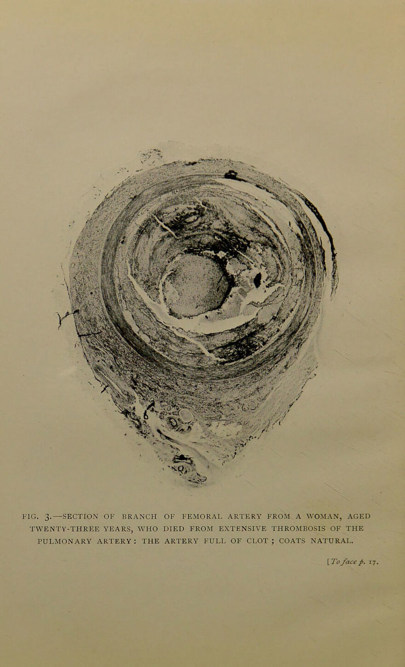 FIG. 3.—SECTION OF BRANCH OF FEMORAL ARTERY FROM A WOMAN, AGED TWENTY-THREE YEARS, WHO DIED FROM EXTENSIVE THROMBOSIS OF THE PULMONARY ARTERY : THE ARTERY FULL OF CLOT ; COATS NATURAL. [To face p. 17