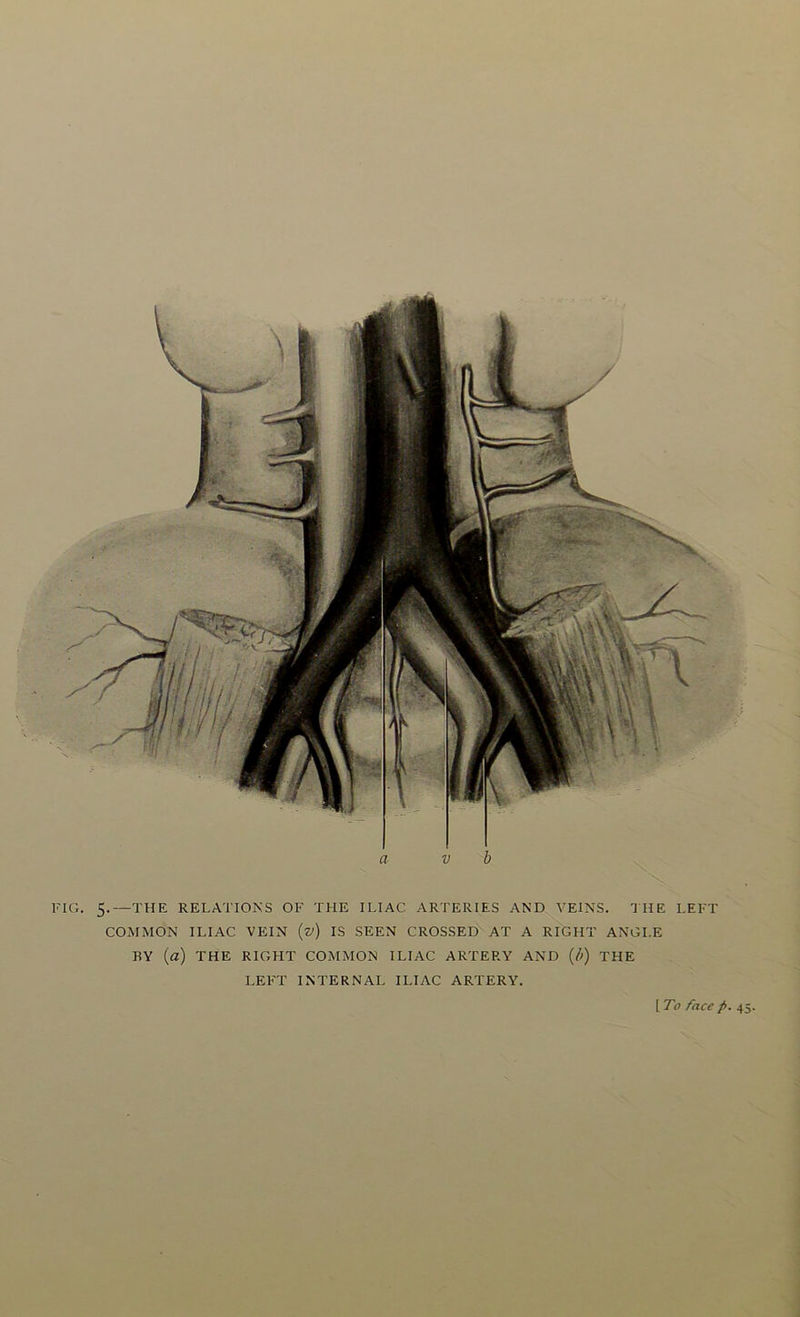 IG. 5.—THE RELATIONS OF THE ILIAC ARTERIES AND VEINS. THE LEFT COMMON ILIAC VEIN (z>) IS SEEN CROSSED AT A RIGHT ANGLE BY (a) THE RIGHT COMMON ILIAC ARTERY AND (/;) THE LEFT INTERNAL ILIAC ARTERY. [ To face p. 45.