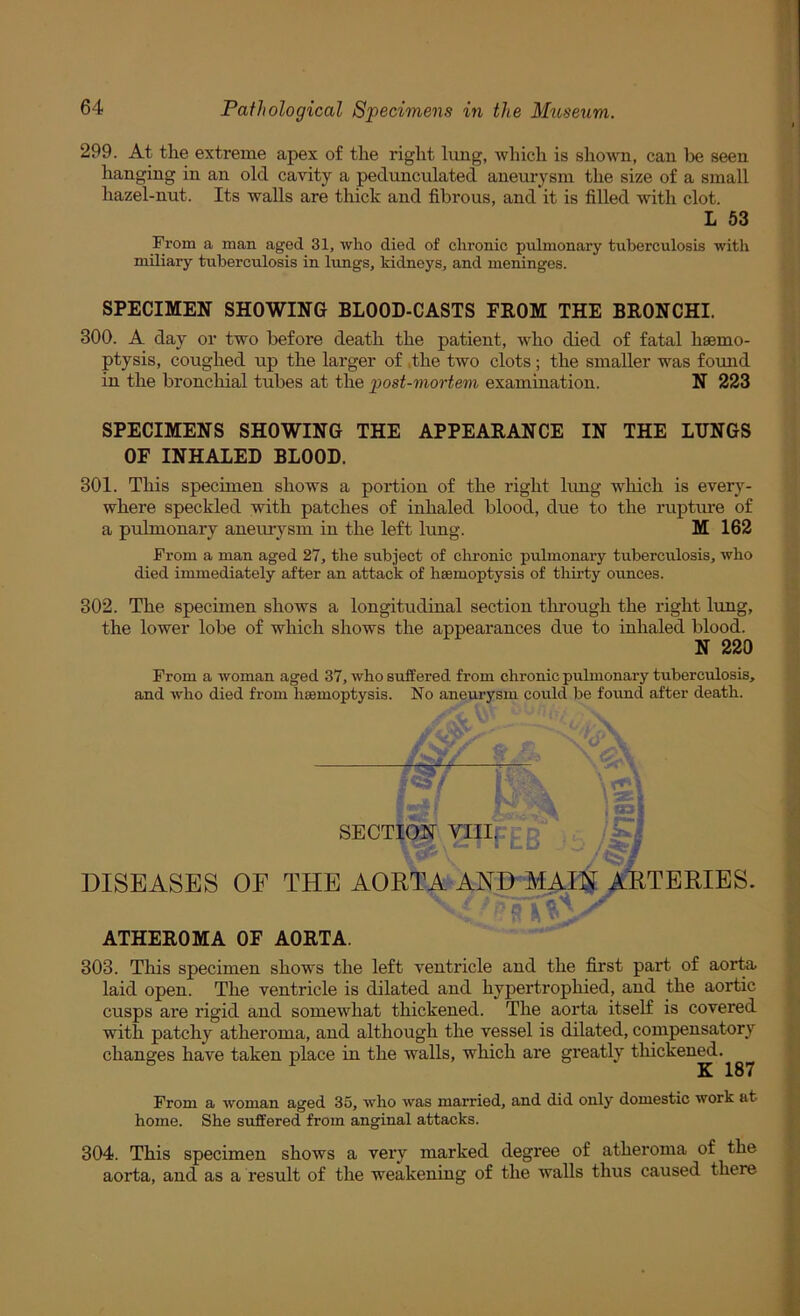 299. At the extreme apex of the right lung, which is shown, can lie seen hanging in an old cavity a pedunculated aneurysm the size of a small hazel-nut. Its walls are thick and fibrous, and it is filled with clot. L 53 From a man aged 31, who died of chronic pulmonary tuberculosis with miliary tuberculosis in limgs, kidneys, and meninges. SPECIMEN SHOWING BLOOD-CASTS FROM THE BRONCHI. 300. A day or two before death the patient, who died of fatal haemo- ptysis, coughed up the larger of ,the two clots; the smaller was foimd in the bronchial tubes at the post-mortem examination. N 223 SPECIMENS SHOWING THE APPEARANCE IN THE LUNGS OF INHALED BLOOD. 301. This specimen shows a portion of the right limg which is every- where speckled with patches of inhaled blood, due to the rupture of a pulmonary anemysm in the left lung. M 162 From a man aged 27, the subject of chronic pulmonary tuberculosis, who died immediately after an attack of haemoptysis of thirty ounces. 302. The specimen shows a longitudinal section tlmough the right lung, the lower lobe of which shows the appearances due to inhaled blood. N 220 From a woman aged 37, who suffered from chronic pulmonary tuberculosis, and who died from haemoptysis. No aneurysm could be found after death. SECTION VIII; DISEASES OF THE AORTA AND MAIN AMBRIES. ATHEROMA OF AORTA. ' 303. This specimen shows the left ventricle and the first part of aorte laid open. The ventricle is dilated and hypertrophied, and the aortic cusps are rigid and somewhat thickened. The aorta itself is covered with patchy atheroma, and although the vessel is dilated, compensatory changes have taken place in the walls, which are greatly thickened. From a woman aged 35, who was married, and did only domestic work at home. She suffered from anginal attacks. 304. This specimen shows a very marked degree of atheroma of the aorta, and as a result of the weakening of the walls thus caused there