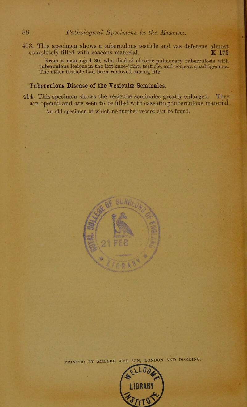 413. This specimen shows a tuberculous testicle and vas deferens almost completely filled with caseous material. K 175 From a man aged 30, who died of clrronic pulmonary tuberculosis with tuberculous lesions in the left knee-joint, testicle, and corpora quadrigemina. The other testicle had been removed during life. Tuberculous Disease of the Vesiculae Seminales. 414. This specimen shows the vesiculae seminales greatly enlarged. They are opened and are seen to be filled with caseating tuberculous material.. An old specimen of which no further record can be fovmd. PRINTED BY ADLARD AND SON, LONDON AND DORKING.