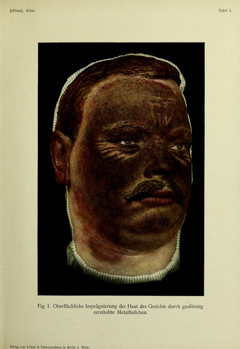 Fig. 1. Oberflächliche Imprägnierung der Haut des Gesichts durch gasförmig zerstäubte Metallteilchen. Verlag von Urban & Schwarzenberg in Berlin u. Wien.