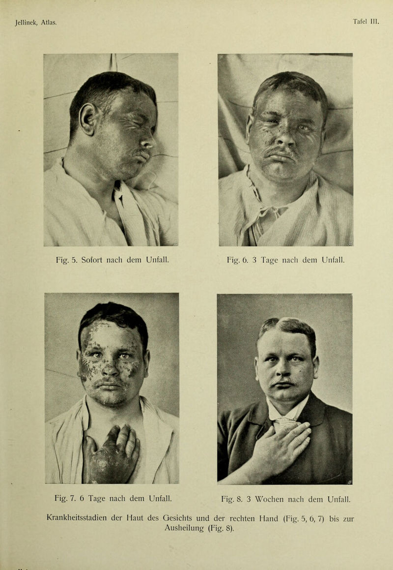 Fig. 5. Sofort nach dem Unfall. Fig. 6. 3 Tage nach dem Unfall. Fig. 7. 6 Tage nach dem Unfall. Fig. 8. 3 Wochen nach dem Unfall. Krankheitsstadien der Haut des Gesichts und der rechten Hand (Fig. 5, 6, 7) bis zur