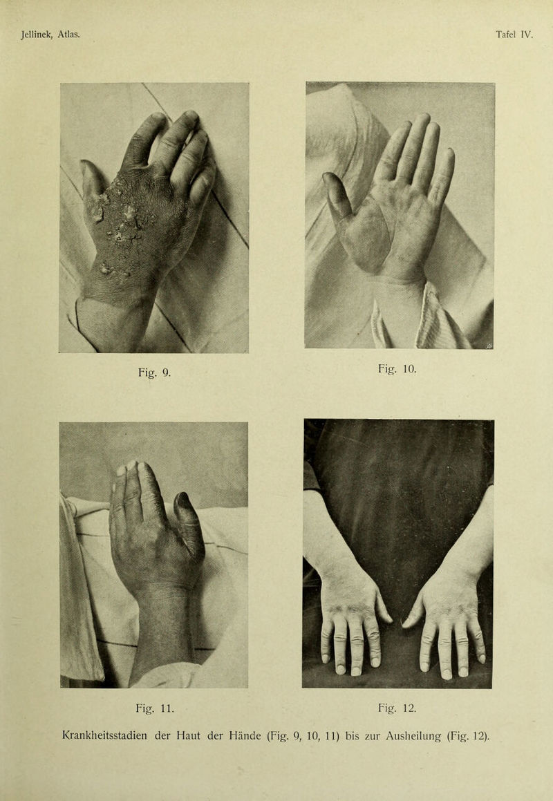 mm M Fig. 11. Fig. 12. Krankheitsstadien der Flaut der Hände (Fig. 9, 10, 11) bis zur Ausheilung (Fig. 12). >T.'A Fig. 10.