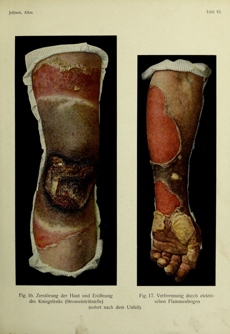Fig. 16. Zerstörung der Haut und Eröffnung des Kniegelenks (Stromeintrittstelle) Fig. 17. Verbrennung durch elektri- schen Flammenbogen (sofort nach dem Unfall).