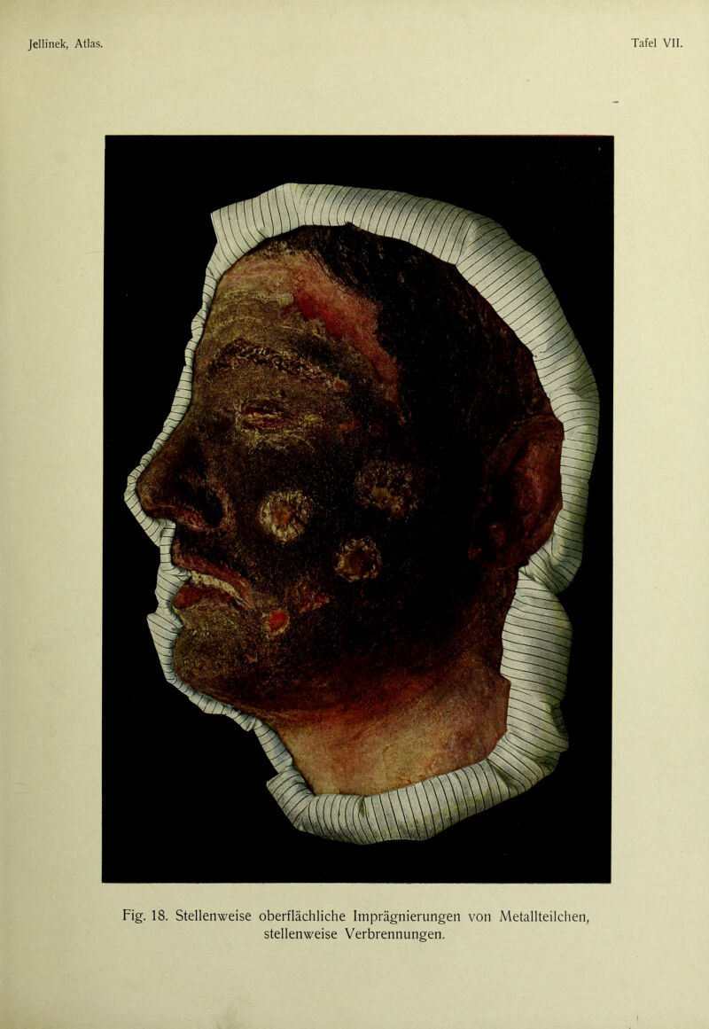 Fig. 18. Stellenweise oberflächliche Imprägnierungen von Metallteilchen, stellenweise Verbrennungen.