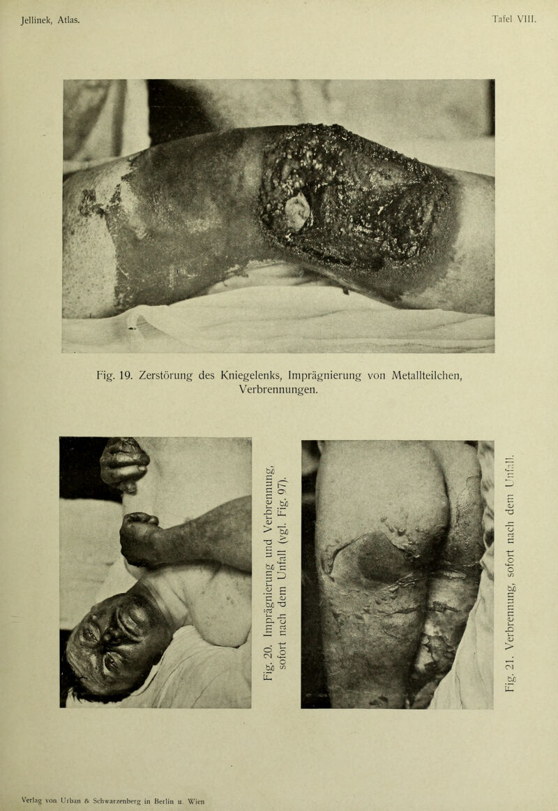 Fig. 19. Zerstörung des Kniegelenks, Imprägnierung von Metallteilchen, Verbrennungen. Verlag von Urban & Schwarzenberg in Berlin u. Wien Fig. 21. Verbrennung, sofort nach dem Unfall.