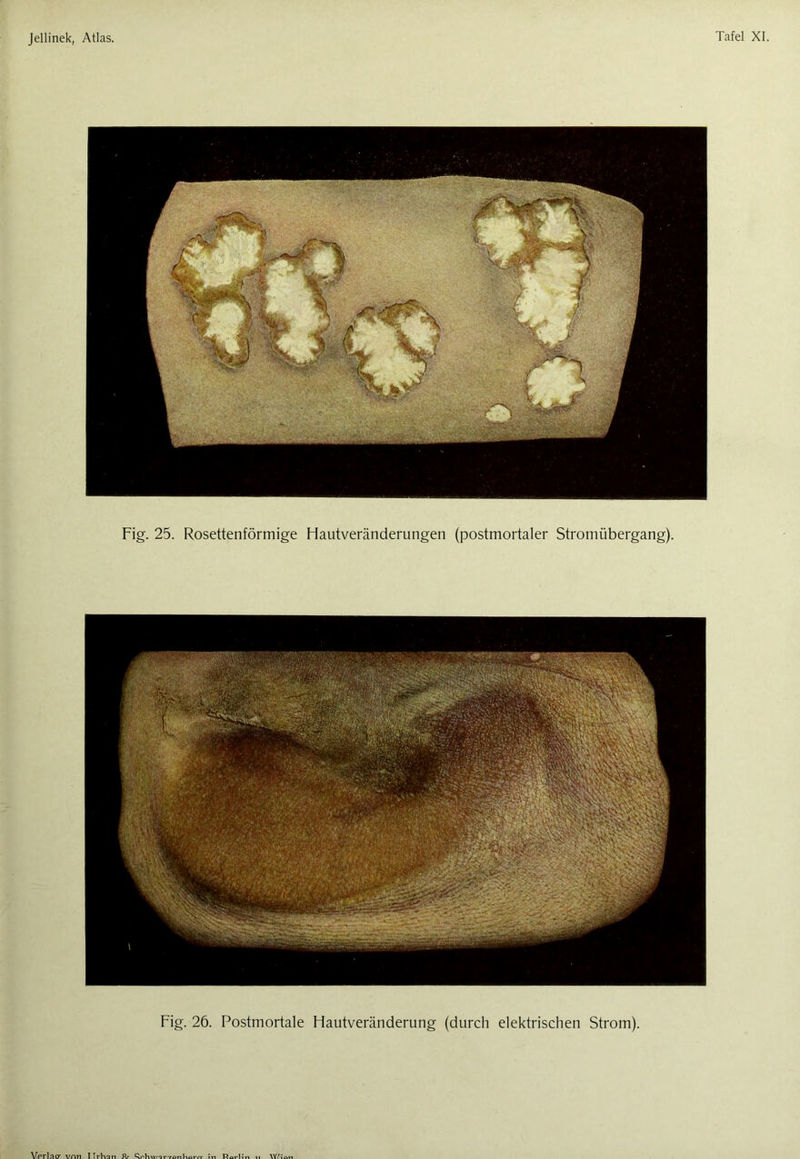 Fig. 25. Rosettenförmige Hautveränderungen (postmortaler Stromübergang). Fig. 26. Postmortale Hautveränderung (durch elektrischen Strom). Vprlno- vntl I Trhan Rr Qf'tnv/ir7ont\fli-nr J ti Rat-Un \Y/«\