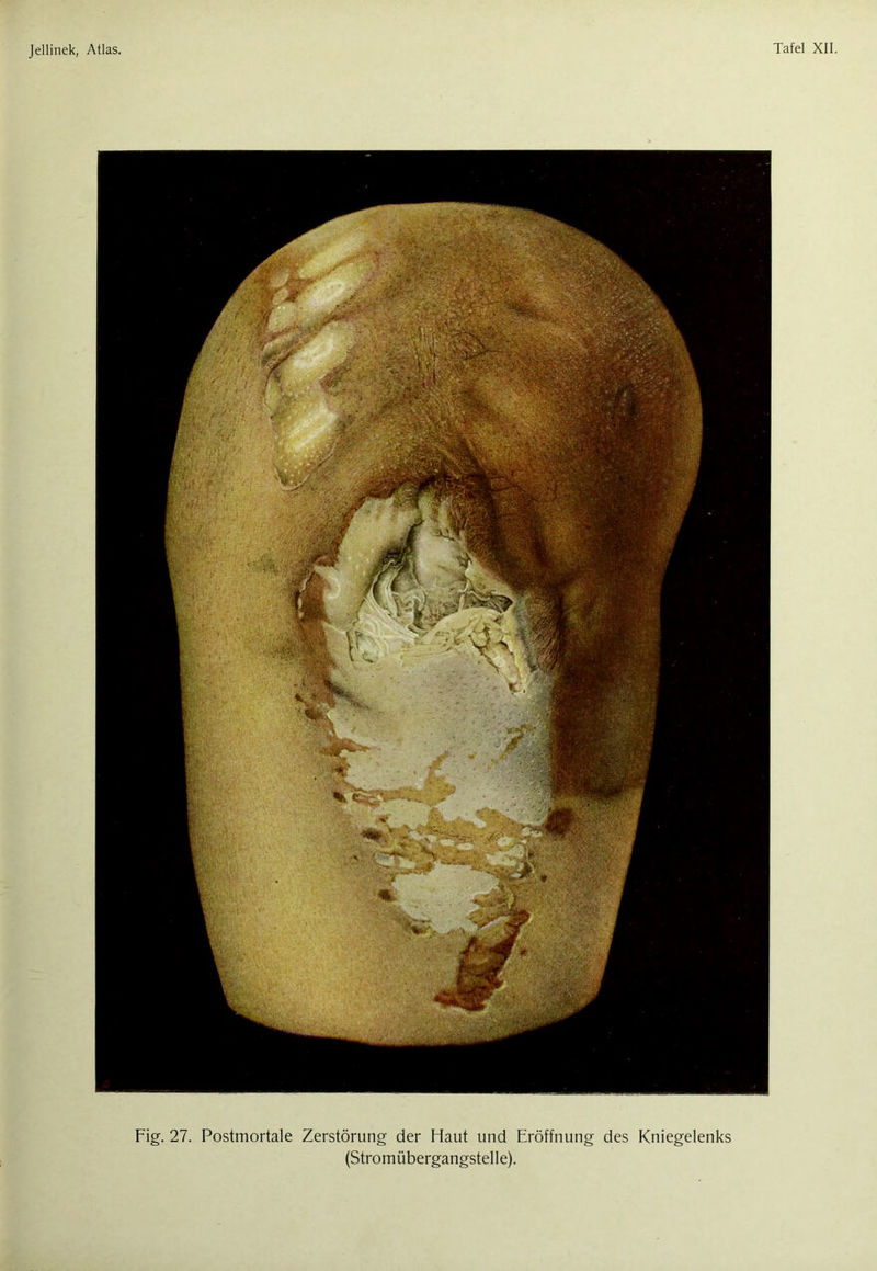 Fig. 27. Postmortale Zerstörung der Haut und Eröffnung des Kniegelenks (Stromübergangstelle).