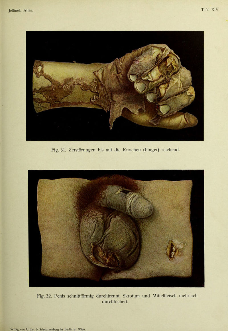 Fig. 31. Zerstörungen bis auf die Knochen (Finger) reichend. Fig. 32. Penis schnittförmig durchtrennt, Skrotum und Mittelfleisch mehrfach durchlöchert.