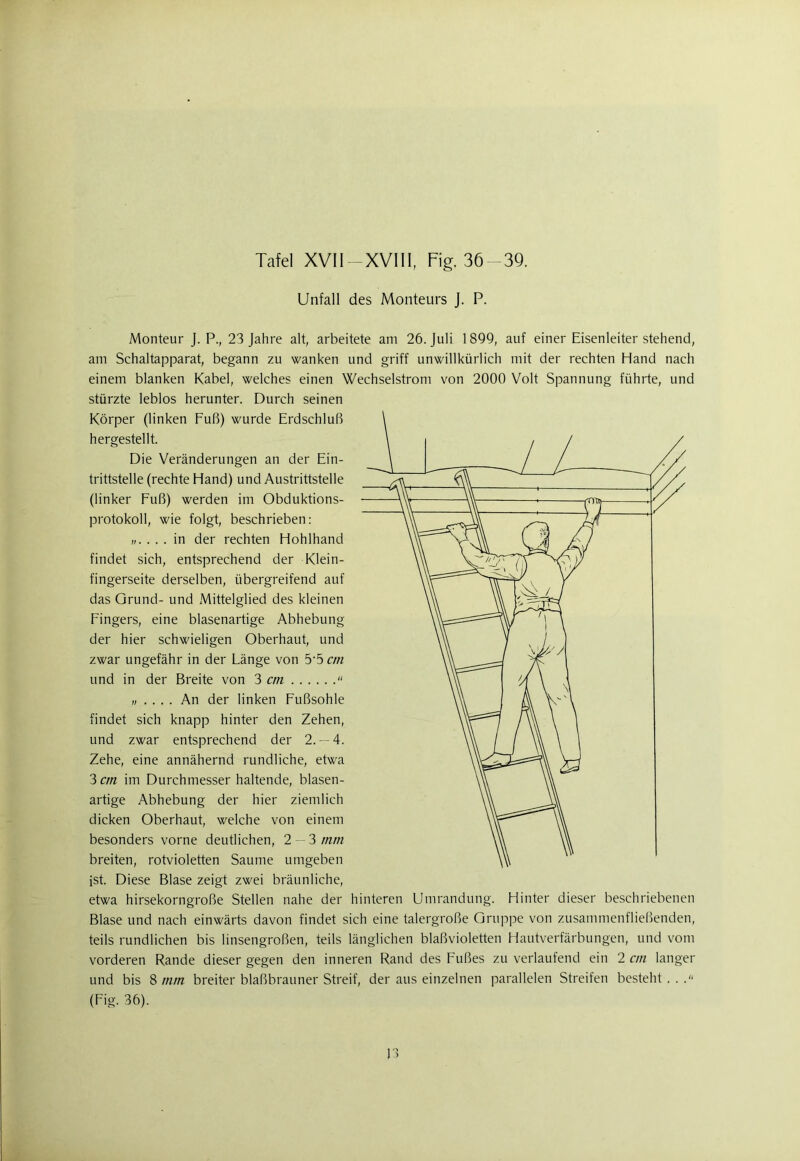 Unfall des Monteurs J. P. Monteur J. P., 23 Jahre alt, arbeitete am 26. Juli 1899, auf einer Eisenleiter stehend, am Schaltapparat, begann zu wanken und griff unwillkürlich mit der rechten Hand nach einem blanken Kabel, welches einen Wechselstrom von 2000 Volt Spannung führte, und stürzte leblos herunter. Durch seinen Körper (linken Fuß) wurde Erdschluß hergestellt. Die Veränderungen an der Ein- trittstelle (rechte Hand) und Austrittstelle (linker Fuß) werden im Obduktions- protokoll, wie folgt, beschrieben: . in der rechten Hohlhand findet sich, entsprechend der Klein- fingerseite derselben, übergreifend auf das Grund- und Mittelglied des kleinen Fingers, eine blasenartige Abhebung der hier schwieligen Oberhaut, und zwar ungefähr in der Länge von 5’5 cm und in der Breite von 3 cm  An der linken Fußsohle findet sich knapp hinter den Zehen, und zwar entsprechend der 2.-4. Zehe, eine annähernd rundliche, etwa 3 cm im Durchmesser haltende, blasen- artige Abhebung der hier ziemlich dicken Oberhaut, welche von einem besonders vorne deutlichen, 2-3 mm breiten, rotvioletten Saume umgeben ist. Diese Blase zeigt zwei bräunliche, etwa hirsekorngroße Stellen nahe der hinteren Umrandung. Hinter dieser beschriebenen Blase und nach einwärts davon findet sich eine talergroße Gruppe von zusammenfließenden, teils rundlichen bis linsengroßen, teils länglichen blaßvioletten Hautverfärbungen, und vom vorderen Rande dieser gegen den inneren Rand des Fußes zu verlaufend ein 2 cm langer und bis 8 mm breiter blaßbrauner Streif, der aus einzelnen parallelen Streifen besteht ... (Fig. 36).