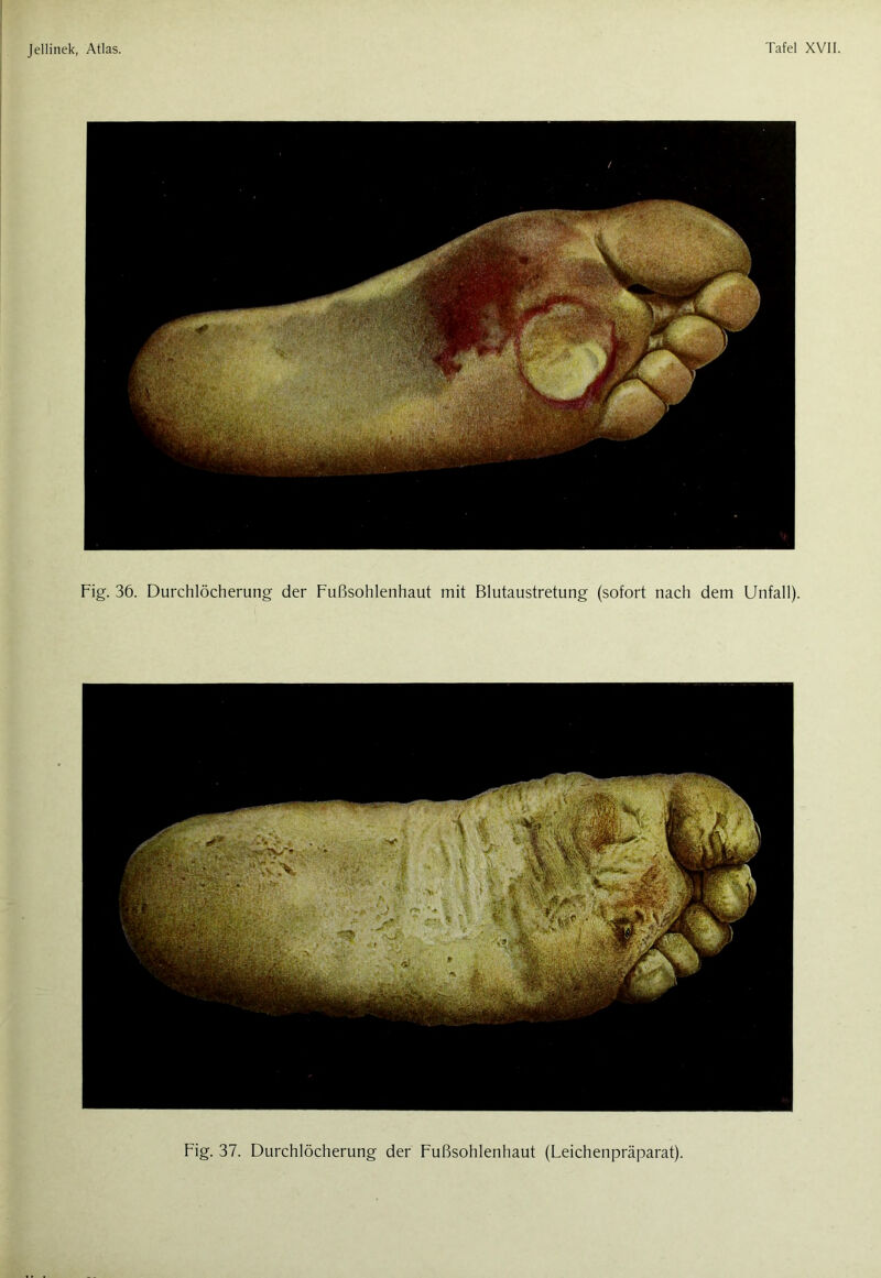 Fig. 36. Durchlöcherung der Fußsohlenhaut mit Blutaustretung (sofort nach dem Unfall). Fig. 37. Durchlöcherung der Fußsohlenhaut (Leichenpräparat)