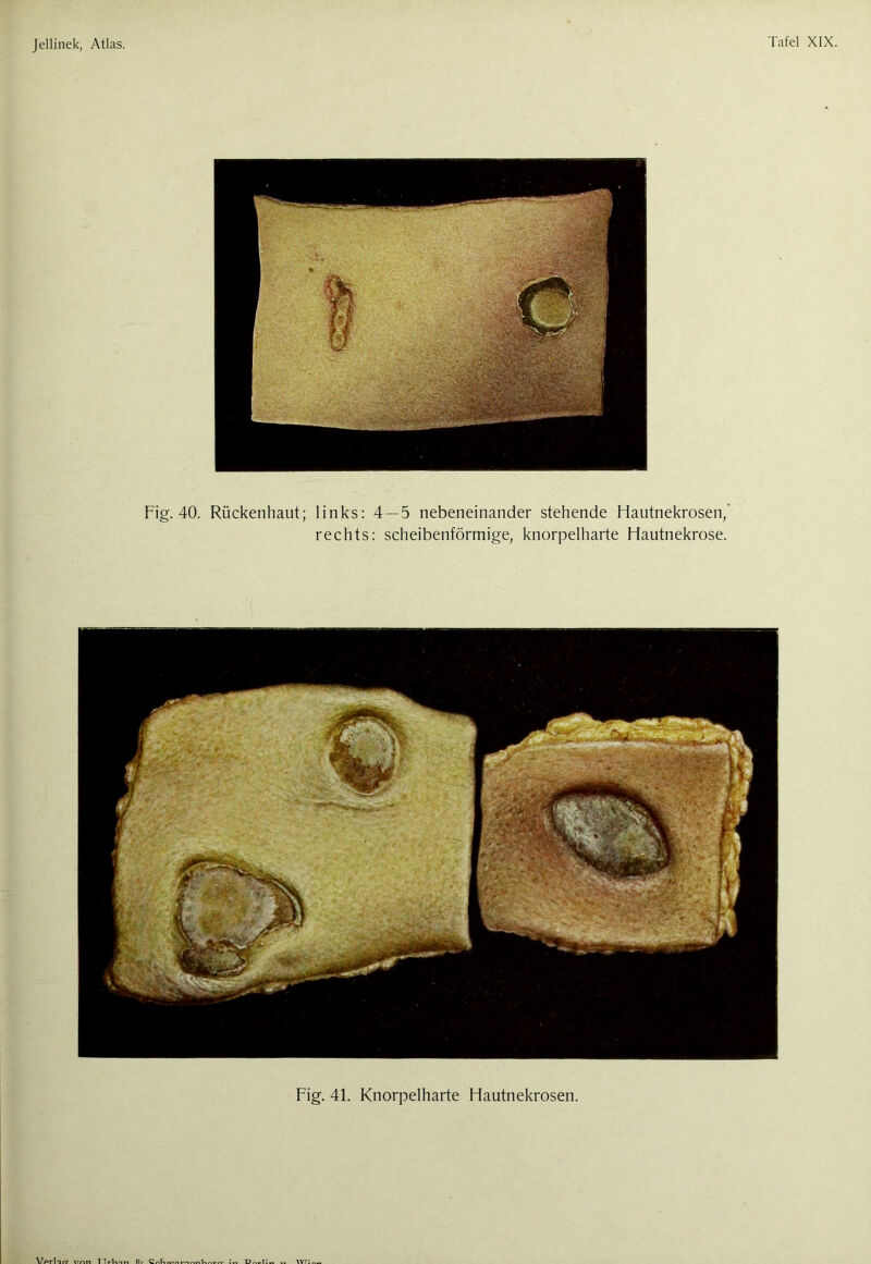 Fig. 40. Rückenhaut; links: 4 — 5 nebeneinander stehende Hautnekrosen/ rechts: scheibenförmige, knorpelharte Hautnekrose. Fig. 41. Knorpelharte Hautnekrosen.