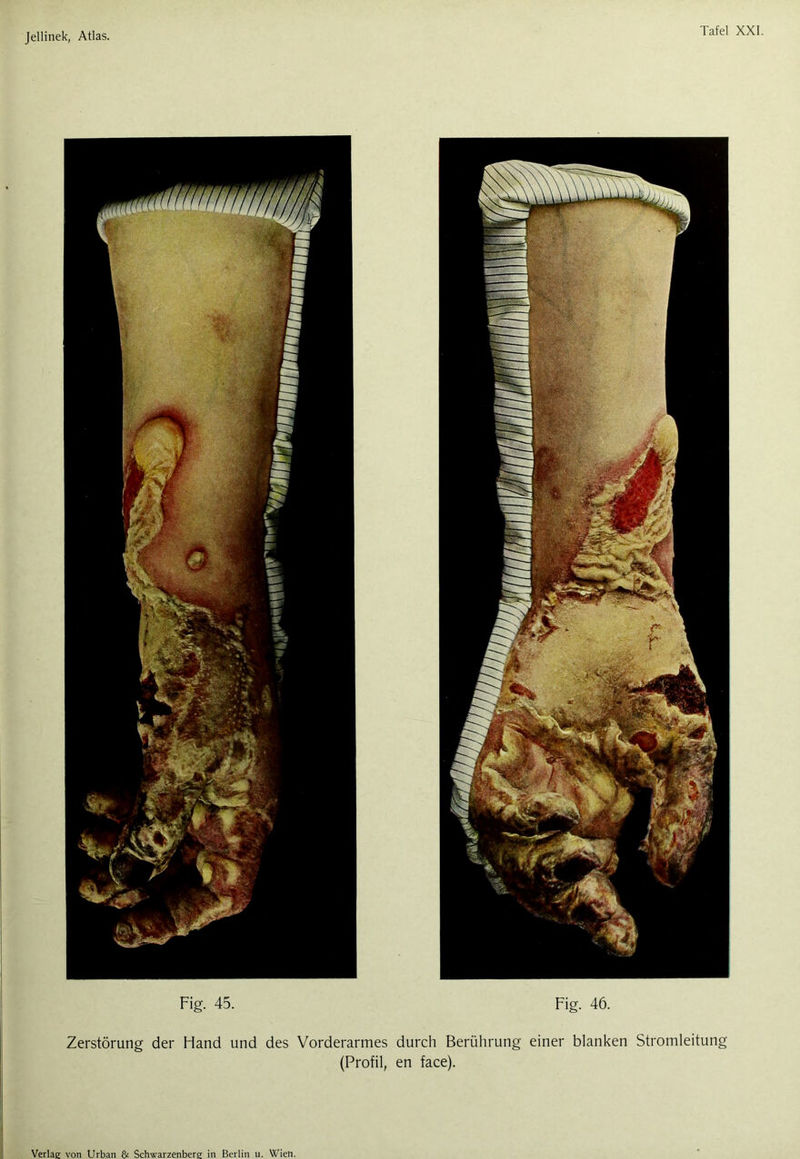 Fig. 45. Fig. 46. Zerstörung der Hand und des Vorderarmes durch Berührung einer blanken Stromleitung (Profil, en face). Verlag von Urban & Schwarzenberg in Berlin u. Wien.