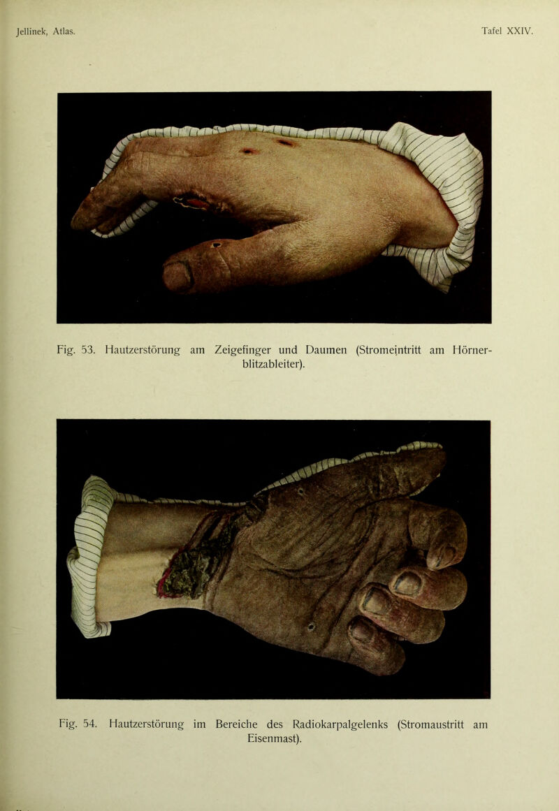 Fig. 53. Hautzerstörung am Zeigefinger und Daumen (Stromeintritt am Hörner- blitzableiter). Fig. 54. Hautzerstörung im Bereiche des Radiokarpalgelenks (Stromaustritt am Eisenmast).