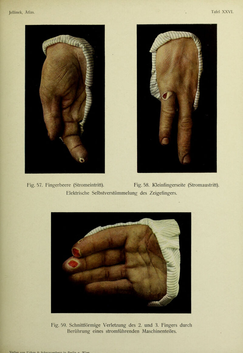 Fig. 57. Fingerbeere (Stromeintritt). Fig. 58. Kleinfingerseite (Stromaustritt). Elektrische Selbstverstümmelung des Zeigefingers.