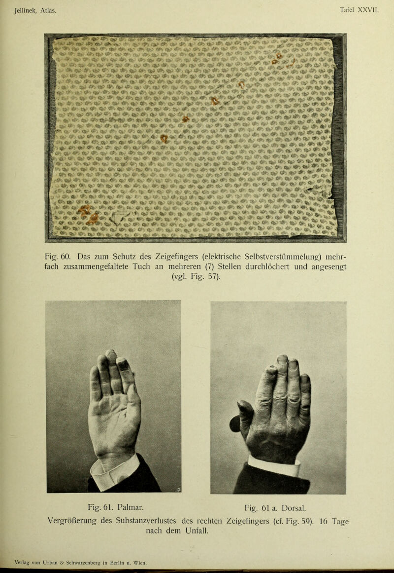 Fig. 60. Das zum Schutz des Zeigefingers (elektrische Selbstverstümmelung) mehr- fach zusammengefaltete Tuch an mehreren (7) Stellen durchlöchert und angesengt (vgl. Fig. 57). Fig. 61. Palmar. Fig. 61 a. Dorsal. Vergrößerung des Substanzverlustes des rechten Zeigefingers (cf. Fig. 59). 16 Tage nach dem Unfall.