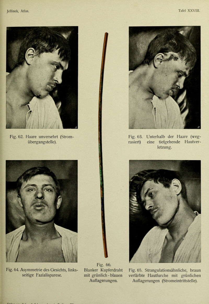 Fig. 62. Haare unversehrt (Strom- übergangstelle). Fig. 64. Asymmetrie des Gesichts, links- seitige Fazialisparese. Fig. 66. Blanker Kupferdraht mit grünlich-blauen Auflagerungen. Fig. 63. Unterhalb der Haare (weg- rasiert) eine tiefgehende Hautver- letzung. Fig. 65. Strangulationsähnliche, braun verfärbte Hautfurche mit grünlichen Auflagerungen (Stromeintrittstelle).