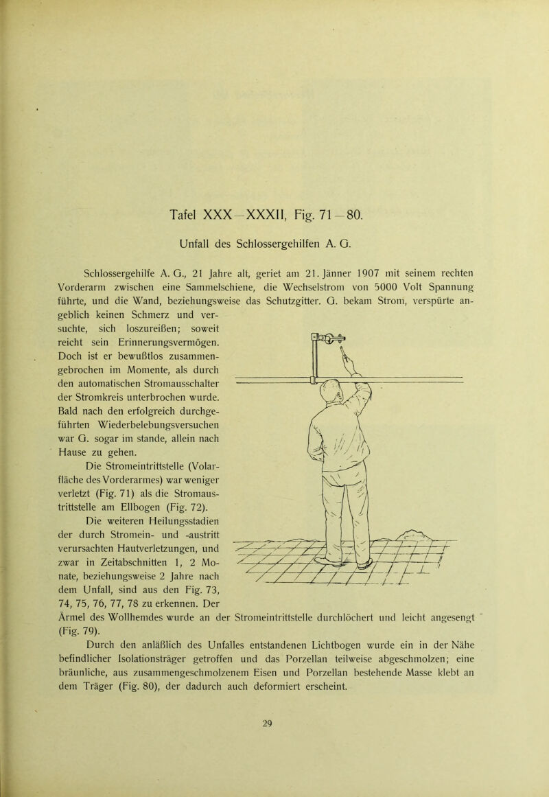Tafel XXX-XXXII, Fig. 71-80. Unfall des Schlossergehilfen A. O. Schlossergehilfe A. G., 21 Jahre alt, geriet am 21. Jänner 1907 mit seinem rechten Vorderarm zwischen eine Sammelschiene, die Wechselstrom von 5000 Volt Spannung führte, und die Wand, beziehungsweise das Schutzgitter. G. bekam Strom, verspürte an- geblich keinen Schmerz und ver- suchte, sich loszureißen; soweit reicht sein Erinnerungsvermögen. Doch ist er bewußtlos zusammen- gebrochen im Momente, als durch den automatischen Stromausschalter der Stromkreis unterbrochen wurde. Bald nach den erfolgreich durchge- führten Wiederbelebungsversuchen war G. sogar im stände, allein nach Hause zu gehen. Die Stromeintrittstelle (Volar- fläche des Vorderarmes) warweniger verletzt (Fig. 71) als die Stromaus- trittstelle am Ellbogen (Fig. 72). Die weiteren Heilungsstadien der durch Stromein- und -austritt verursachten Hautverletzungen, und zwar in Zeitabschnitten 1, 2 Mo- nate, beziehungsweise 2 Jahre nach dem Unfall, sind aus den Fig. 73, 74, 75, 76, 77, 78 zu erkennen. Der Ärmel des Wollhemdes wurde an der Stromeintrittstelle durchlöchert und leicht angesengt (Fig. 79). Durch den anläßlich des Unfalles entstandenen Lichtbogen wurde ein in der Nähe befindlicher Isolationsträger getroffen und das Porzellan teilweise abgeschmolzen; eine bräunliche, aus zusammengeschmolzenem Eisen und Porzellan bestehende Masse klebt an dem Träger (Fig. 80), der dadurch auch deformiert erscheint.