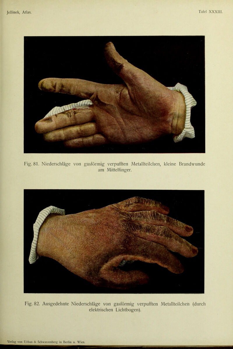 Fig. 81. Niederschläge von gasförmig verpufften Metallteilchen, kleine Brandwunde am Mittelfinger. Fig. 82. Ausgedehnte Niederschläge von gasförmig verpufften Metallteilchen (durch elektrischen Lichtbogen).