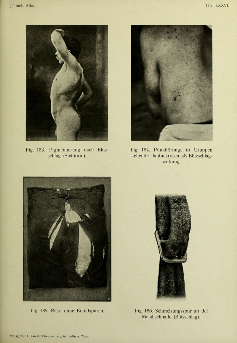 Fig. 183. Pigmentierung nach Blitz- schlag (Spätform). Fig. 184. Punktförmige, in Gruppen stehende Hautnekrosen als Blitzschlag- wirkung. Fig. 185. Risse ohne Brandspuren. Fig. 186. Schmelzungsspur an der Metallschnalle (Blitzschlag).