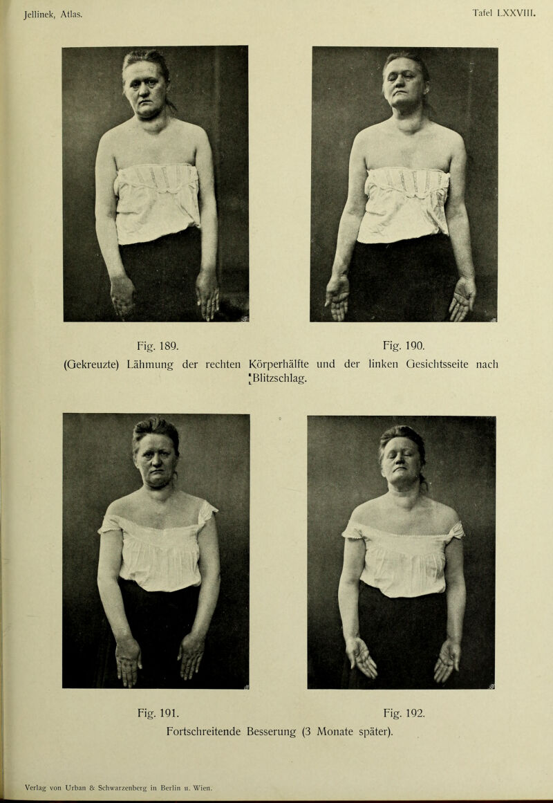 Fig. 189. Fig. 190. (Gekreuzte) Lähmung der rechten Körperhälfte und der linken Gesichtsseite nach ‘Blitzschlag. Fig. 191. Fig. 192. Fortschreitende Besserung (3 Monate später).