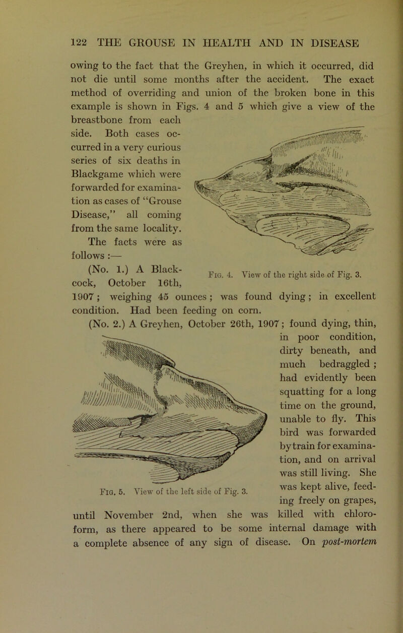 Fig. 4. View of tlie right side of Fig. 3. owing to the fact that the Greyhen, in which it occurred, did not die until some months after the accident. The exact method of overriding and union of the broken bone in this example is shown in Figs. 4 and 5 which give a view of the breastbone from each side. Both cases oc- curred in a very curious series of six deaths in Blackgame which were forwarded for examina- tion as cases of “Grouse Disease,” all coming from the same locality. The facts were as follows :— (No. 1.) A Black- cock, October 16th, 1907; weighing 45 ounces; was found dying; in excellent condition. Had been feeding on corn. (No. 2.) A Greyhen, October 26th, 1907; found dying, thin, in poor condition, dirty beneath, and much bedraggled ; had evidently been squatting for a long time on the ground, unable to fly. This bird was forwarded by train for examina- tion, and on arrival was still living. She was kept alive, feed- ing freely on grapes, until November 2nd, when she was killed with chloro- form, as there appeared to be some internal damage with a complete absence of any sign of disease. On post-mortem Fig. 5. View of the left side of Fig. 3.