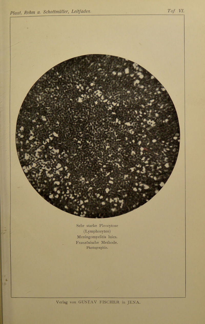 Sehr starke Pleocytose (Lymphozyten) Meningomyelitis luica. Französische Methode. Photographie.