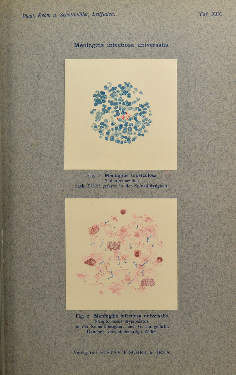 ■M a. Meningitis infectiosa universalis. :r VX'; j v X'.c i. K.c KI8L-- m . ; :K<- ;> \ - J'- rfv.pT«. ft*-'* ' Ab V’ ; Äs At.: - ^ * «L* m j y j «> f.vsKV, v.<' '.W1 j ,, s ’ }.- • \»■ .-wvu Stf : yV-;r v.;fy.- A-, •/’. ::>• ' ■i ii',* v s ■ •st* . ■..v'> .Äb. ‘ • '• -rt*V /*V' *-r. V\ /- .i - ■ •£-. ; ;. •$>'.• ;■£ BrAi* -■ . ' >5£:5v -»■ «v*-.* <*•-. är: ;v ttk • .* ' 4,. '„'i*’. V ,-r .• ■S\ s ä - ;••• ■ ■■-;} S^|p£| &§|p V %fP*ö;Sy., : •-. .;cv' .» :.-X .-. .'USE* . ’&v-; '>•••-• ' 1 v. -- • ’ >■ „#Ä;1 • lr; *•< . •/« . -yy i -...;%:^,v;.::r ;y.y • * >.« «*:•■• VI- . — : ’ ;———— Fig. i. Meningitis tuberculosa Tuberkelbazillen nach Zieh! gefärbt in der Spinalflüssigkeit. ■ I ■*, •b . V - .•• xjussy. r Fig. 2. Meningitis infectiosa universalis. Streptococcus erysipelatos, in der Spinalflüssigkeit nach Gram gefärbt. Daneben veischiedenartige Zellen. . _ ■'» »Vr -V • .'VV. 7- ' M bbrfair f. 7‘ . .. Verlag von GUSTAV FISCHER in JENA. V* fr