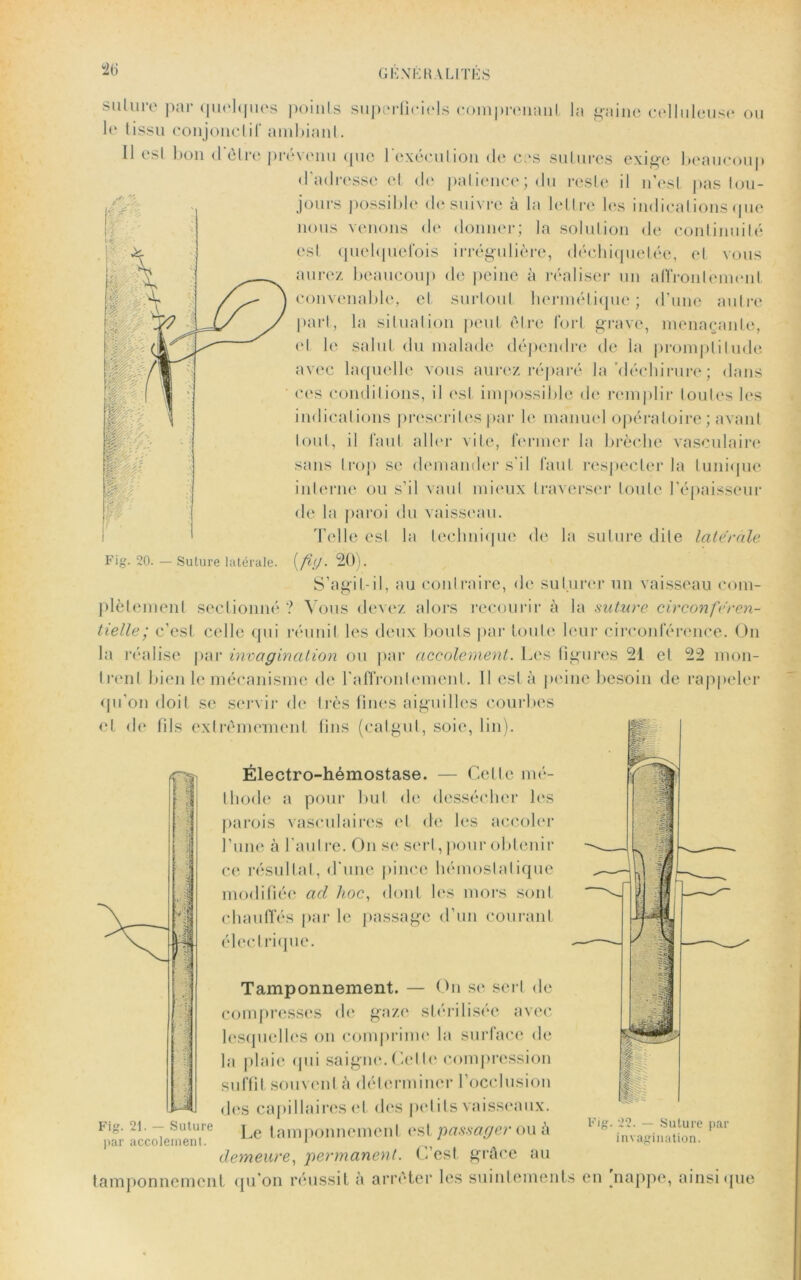 T S suture par quelques points superficiels coinj)rcnanl la gaine celluleuse on le tissu conjonctif ambiant. Il est bon <1 être prévenu que l'exécution de ces sutures exige beaucoup d'adresse et de patience; du reste il n’est pas tou- jours possible de suivre à la lettre les indications que nous venons de donner; la solution de continuité est quelquefois irrégulière, déchiquetée, et vous aurez beaucoup de peine à réaliser un affrontement convenable, et surtout hermétique; d’une autre part, la situation peut être fort grave, menaçante, et le salut du malade dépendre de la promptitude avec laquelle vous aurez réparé la “déchirure ; dans ces conditions, il est impossible de remplir toutes les indications prescrites par le manuel opératoire ; avant tout, il faut aller vite, fermer la brèche vasculaire sans trop se demander s’il faut respecter la tunique interne ou s’il vaut mieux traverser toute l’épaisseur de la paroi du vaisseau. Telle esl la technique de la suture dite latérale Fig. 20. — Suture latérale. (/?//• 20). S’agit-il, au cou!faire, de suturer un vaisseau com- plètement sectionné ? Vous devez alors recourir à la suture circonféren- tielle ; c’est celle qui réunit les deux bouts par toute leur circonférence. On la réalise par invagination ou par accotement. Les figures 21 et 22 mon- trent bien le mécanisme de l'affronlement. Il est a peine besoin de rappeler qu'on doit se servir de très fines aiguilles courbes et de fils extrêmement fins (catgut, soie, lin). Électro-hémostase. — Cette mé- thode ii pour bul de dessécher les parois vasculaires et de les accoler l’une à l'autre. On se sert, pour obtenir ce résultat, d’une pince hémostatique modifiée ad hoc, dont les mors sont chauffés par le passage d’un courant électrique. Tamponnement. — On se sert de compresses de gaze stérilisée avec lesquelles on comprime la surface de la plaie qui saigne. Cette compression suffit souvent à déterminer l’occlusion dos capillaires et des petits vaisseaux. *iagr—tr Le tamponnement est ou à lig'par demeure, permanent. C’est grâce au tamponnement qu’on réussit à arrêter les suintements en nappe, ainsique