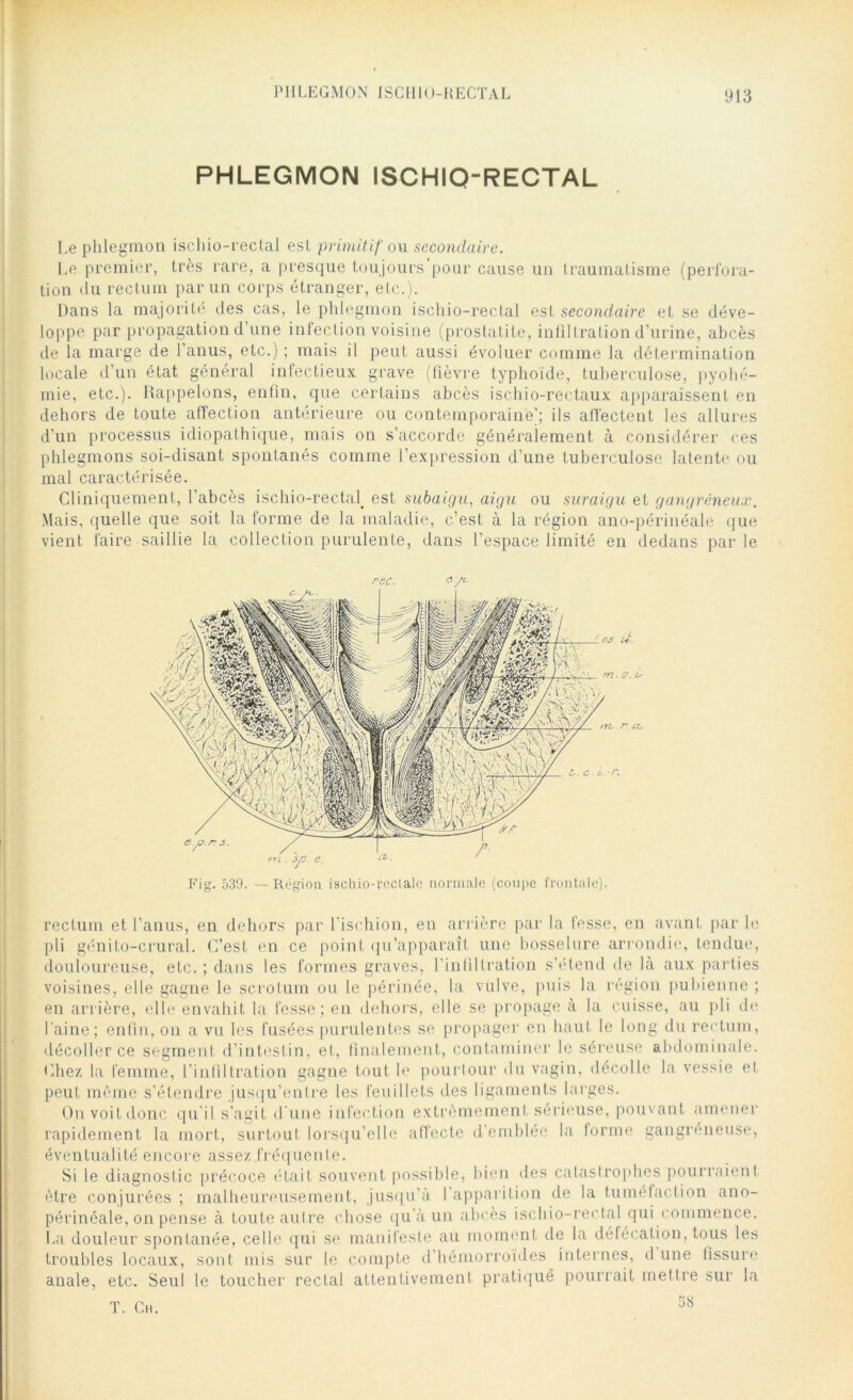 PHLEGMON ISCHIO-RECTAL PHLEGMON ISCHIQ-RECTAL Le phlegmon ischio-rectal est primitif cm secondaire. Le premier, très rare, a presque toujours pour cause un traumatisme (perfora- tion du rectum par un corps étranger, etc.). Dans la majorité des cas, le phlegmon ischio-rectal est secondaire et se déve- loppe par propagation d’une infection voisine (prostatite, infiltration d’urine, abcès de la marge de l’anus, etc.) ; mais il peut aussi évoluer comme la détermination locale d’un état général infectieux grave (fièvre typhoïde, tuberculose, pyohé- mie, etc.). Rappelons, enfin, que certains abcès ischio-rectaux apparaissent en dehors de toute affection antérieure ou contemporaine'; ils affectent les allures d’un processus idiopathique, mais on s'accorde généralement à considérer ces phlegmons soi-disant spontanés comme l’expression d’une tuberculose latente ou mal caractérisée. Cliniquement, l’abcès ischio-rectal. est subaigu, aigu ou suraigu et gangréneux. Mais, quelle que soit la forme de la maladie, c’est à la région ano-périnéale que vient faire saillie la collection purulente, dans l’espace limité en dedans par le rec. &'■/<- Fig. 530. — Région ischio-reclale normale (coupe frontale). rectum et l’anus, en dehors par l’ischion, en arrière par la fesse, en avant par le pli génito-crural. C’est en ce point qu’apparaît une bosselure arrondie, tendue, douloureuse, etc. ; dans les formes graves, l’infiltration s’étend de là aux parties voisines, elle gagne le scrotum ou le périnée, la vulve, puis la région pubienne ; en arrière, elle envahit la fesse; en dehors, elle se propage à la cuisse, au pli de l'aine; enfin, on a vu les fusées purulentes se propager en haut le long du rectum, décoller ce segment d’intestin, et, finalement, contaminer le séreuse abdominale. Chez la femme, l’intlltration gagne tout le pourtour du vagin, décolle la vessie et peut même s’étendre jusqu’entre les feuillets des ligaments larges. On voit donc qu’il s’agit d’une infection extrêmement sérieuse, pouvant amener rapidement la mort, surtout lorsqu’elle affecte d'emblée la forme gangreneuse, éventualité encore assez fréquente. Si le diagnostic précoce était souvent possible, bien des catastrophes pourraient être conjurées ; malheureusement, jusqu’à l’apparition de la tuméfaction ano- périnéale, on pense à toute autre chose qu’à un abcès ischio-rectal qui commence. La douleur spontanée, celle qui se manifeste au moment de la défécation, tous les troubles locaux, sont mis sur le compte d’hémorroïdes internes, d une fissure anale, etc. Seul le toucher rectal attentivement pratiqué pourrait mettre sur la 38 T. Ch.