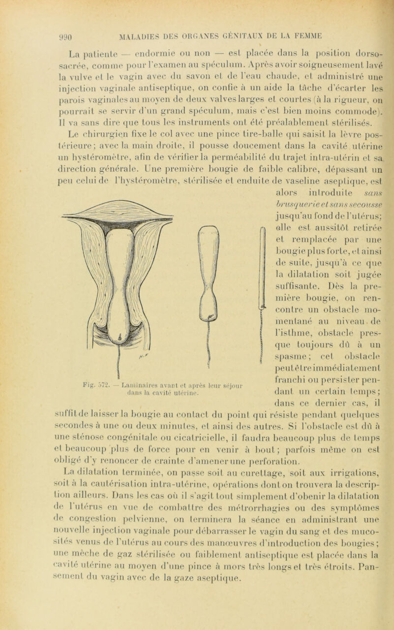 La patiente — endormie ou non — est placée dans la position dorso- sacrée, comme pour l’examen au spéculum. Après avoir soigneusement lavé la vulve et le vagin avec du savon et de l'eau chaude, et administré une injection vaginale antiseptique, on confie à un aide la tâche d’écarter les parois vaginales au moyen de deux valves larges et courtes (à la rigueur, on pourrait se servir d’un grand spéculum, mais c’est bien moins commode). Il va sans dire que tous les instruments ont été préalablement stérilisés. Le chirurgien fixe le col avec une pince tire-balle qui saisit la lèvre pos- térieure; avec la main droite, il pousse doucement dans la cavité utérine un hystéromètre, afin de vérifier la perméabilité du trajet intra-utérin et sa direction générale. Une première bougie de faible calibre, dépassant un peu celui de l’hystéromètre, stérilisée et enduite de vaseline aseptique, est alors introduite sans brusquerie cl sans secousse jusqu’au fond de l’utérus; elle est aussitôt retirée et remplacée par une bougie plus forte, et ainsi de suite, jusqu’à ce que la dilatation soit jugée suffisante. Dès la pre- mière bougie, on ren- contre un obstacle mo- mentané au niveaude l’isthme, obstacle pres- que toujours dû à un spasme ; cet obstacle p e u t ê tr e i m m é d i a t em en l franchi ou persister pen- dant un certain temps; dans ce dernier cas, il suffit de laisser la bougie au contact du point qui résiste pendant quelques secondes à une ou deux minutes, et ainsi des autres. Si l’obstacle est dû à une sténose congénitale ou cicatricielle, il faudra beaucoup plus de temps et beaucoup plus de force pour en venir à bout; parfois même on est obligé d’y renoncer de crainte d’amener une perforation. La dilatation terminée, on passe soit au curettage, soit aux irrigations, soit a la cautérisation intra-utérine, opérations don ton trouvera la descrip- tion ailleurs. Dans les cas où il s’agit tout simplement d’obenir la dilatation de 1 utérus en vue de combattre des métrorrhagies ou des symptômes de congestion pelvienne, on terminera la séance en administrant une nouvelle injection vaginale pour débarrasser le vagin du sang et des muco- sités venus de l’utérus au cours des manœuvres d’introduction des bougies; une mèche de gaz stérilisée ou faiblement antiseptique est placée dans la vavite utérine au moyen d’une pince à mors très longs et très étroits. Pan- sement du vagin avec de la gaze aseptique. Fig. .Ï72. — Laminaires avant et après leur séjour dans la cavité utérine.