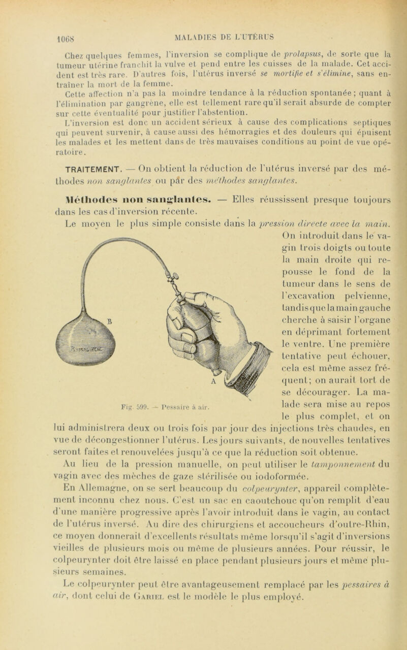 Chez quelques femmes, l’inversion se complique de prolapsus, de sorte que la tumeur utérine franchit la vulve et pend entre les cuisses de la malade. Cet acci- dent est très rare. D’autres fois, l’utérus inversé se mortifie et s'élimine, sans en- traîner la mort de la femme. Cette affection n’a pas la moindre tendance à la réduction spontanée; quant à l’élimination par gangrène, elle est tellement rare qu’il serait absurde de compter sur cette éventualité pour justifier l’abstention. L’inversion est donc un accident sérieux à cause des complications septiques qui peuvent survenir, à cause aussi des hémorragies et des douleurs qui épuisent les malades et les mettent dans de très mauvaises conditions au point de vue opé- ratoire. TRAITEMENT. — On obtient la réduction de l’utérus inversé par des mé- thodes non sanglantes ou pdr des méthodes sanglantes. Méthodes non sanglantes. — Elles réussissent presque toujours dans les cas d’inversion récente. Le moyen le plus simple consiste dans la pression directe avec la main. On introduit dans le va- gin trois doigts ou toute la main droite qui re- pousse le fond de la tumeur dans le sens de l’excavation pelvienne, tandis que la main gauche cherche à saisir l’organe en déprimant fortement le ventre. Une première tentative peut échouer, cela est même assez fré- quent; on aurait tort de se décourager. La ma- Fi. 599. — Pessaire à air lade sera mise au repos le plus complet, et on lui administrera deux ou trois fois par jour des injections très chaudes, en vue de décongestionner l’utérus. Les jours suivants, de nouvelles tentatives seront faites et renouvelées jusqu’à ce que la réduction soit obtenue. Au lieu de la pression manuelle, on peut utiliser le tamponnement du vagin avec des mèches de gaze stérilisée ou iodoformée. En Allemagne, on se sert beaucoup du colpcuryntcr, appareil complète- ment inconnu chez nous. C’est un sac en caoutchouc qu’on remplit d’eau d’une manière progressive après l’avoir introduit dans ie vagin, au contact de l’utérus inversé. Au dire des chirurgiens et accoucheurs d’outre-Ehin, ce moyen donnerait d’excellents résultats même lorsqu’il s’agit d’inversions vieilles de plusieurs mois ou même de plusieurs années. Pour réussir, le colpeurynter doit être laissé en place pendant plusieurs jours et même plu- sieurs semaines. Le colpeurynter peut être avantageusement remplacé par les pessaires à air, dont celui de Gariel est le modèle le plus employé.