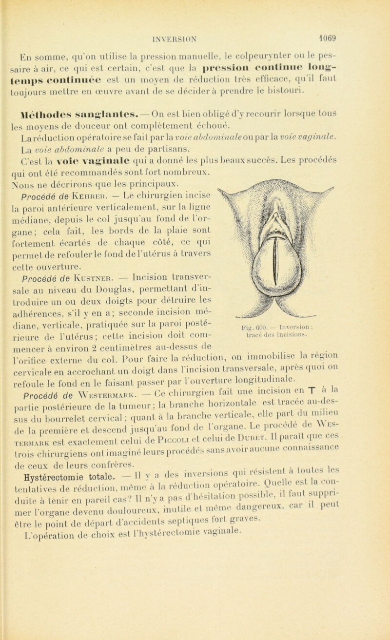 En somme, qu’on utilise la pression manuelle, le colpeurynter ou le pes- saire à air, ce qui est certain, c’est que la pression continue long- temps continuée est un moyen de réduction très efficace, qu’il faut toujours mettre en œuvre avant de se décider à prendre le bistouri. Méthodes sanglantes. — On est bien obligé d’y recourir lorsque tous les moyens de douceur ont complètement échoué. La réduction opératoire se fait par la voie abdominale on par la voie vaginale. La voie abdominale a peu de partisans. C’est la voie vaginale qui a donné les plus beaux succès. Les procédés qui ont été recommandés sont fort nombreux. Nous ne décrirons que les principaux. Procédé de Kehrer. — Le chirurgien incise la paroi antérieure verticalement, sur la ligne médiane, depuis le col jusqu’au fond de l'or- gane; cela fait, les bords de la plaie sont fortement écartés de chaque côté, ce qui permet de refouler le fond de l’utérus à travers celte ouverture. Procédé de Ivustner. — Incision transver- sale au niveau du Douglas, permettant d’in- troduire un ou deux doigts pour détruire les adhérences, s’il y en a; seconde incision mé- diane, verticale, pratiquée sur la paroi posté- rieure de l’utérus; cette incision doit com- mencer à environ 2 centimètres au-dessus de l'orifice externe du col. Pour faire la réduction, on immobilise la région cervicale en accrochant un doigt dans 1 incision transversale, a pus quoi on refoule le fond en le faisant passer par l’ouverture longitudinale. Procédé de Westebmabk. — Ce chirurgien fait une incision en T a a partie postérieure de la tumeur; la branche horizontale est tracée au-des- sus du bourrelet cervical ; quant à la branche verticale, elle part du milieu de la première et descend jusqu’au tond de 1 organe. Le pioi < < e c e ii termabk est exactement celui de Piccoli cl celui de Dubet. Il parait que ces trois chirurgiens ont imaginé leurs procèdes sans a\ ou aucune de ceux de leurs confrères. . , iPQ Hystérectomie totale. — H y a des îmersions qui icsis cn . r tentatives de réduction, même à la réduction opératoire. Que 1 est la con duite à tenir en pareil cas? 11 n’y a pas d'hésitation possible, il faut s. PP j mer l’organe devenu douloureux, inutile et meme dang< h ux, être le point de départ d accidents septiques loil gia L’opération de choix est i’hystérectomie vaginale. Fig. 600. — Inversion ; Iracé des incisions.