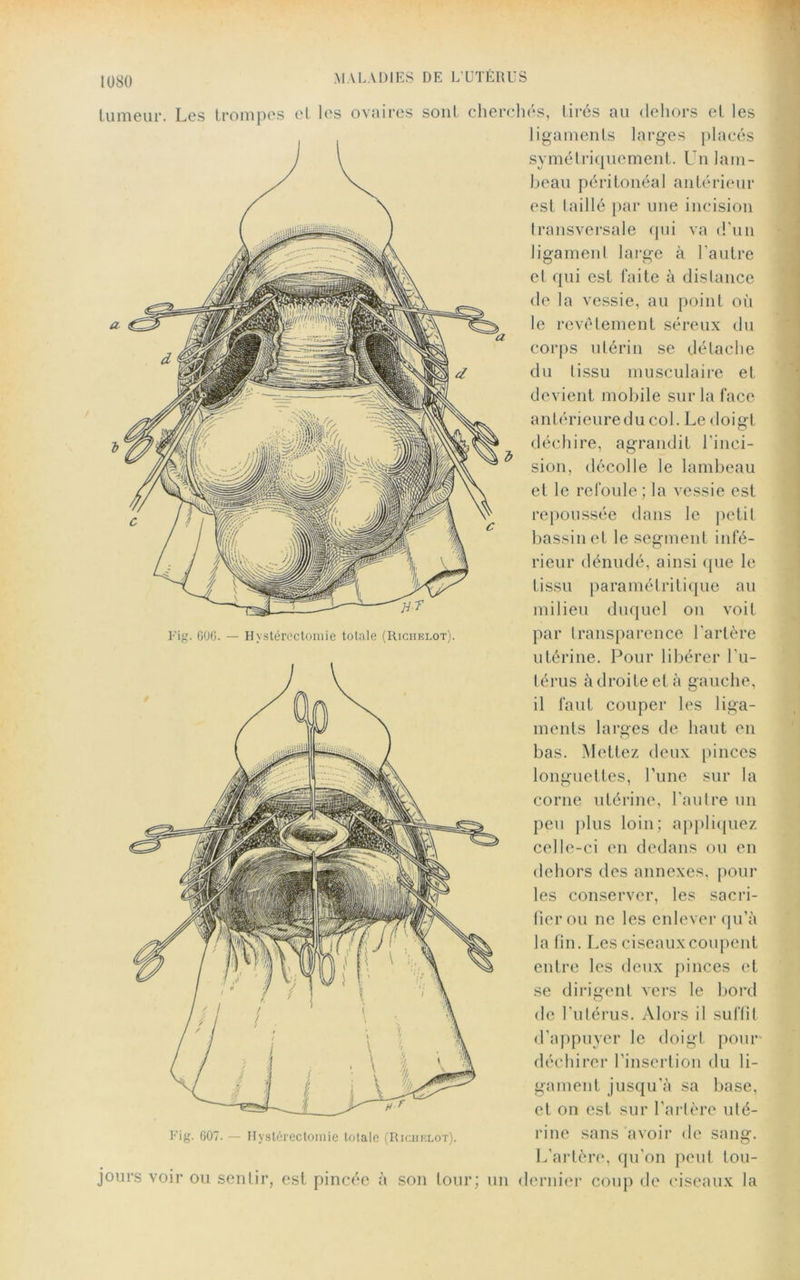 Fig. 606. — Hystérectomie totale (Riciielot). tumeur. Les trompes et les ovaires sont cherchés, tirés au dehors et les ligaments larges placés symétriquement. Un lam- beau péritonéal antérieur est taillé par une incision transversale qui va d'un ligament large à l’autre et qui est faite à distance de la vessie, au point où le revêtement séreux du corps utérin se détache du tissu musculaire et devient mobile sur la face antérieuredu col. Le doigt déchire, agrandit l'inci- sion, décolle le lambeau et le refoule; la vessie est repoussée dans le petit bassinet le segment infé- rieur dénudé, ainsi que le tissu paramétritique au milieu duquel on voit par transparence l'artère utérine. Pour libérer l’u- térus à droite et à gauche, il faut couper les liga- ments larges de haut en bas. Mettez deux pinces longuettes, l’une sur la corne utérine, l’autre un peu plus loin; appliquez celle-ci en dedans ou en dehors des annexes, pour les conserver, les sacri- fier ou ne les enlever qu’à la fin. Les ciseaux coupent entre les deux pinces et se dirigent vers le bord de l’utérus. Alors il suffit d’appuyer le doigt pour déchirer l’insertion du li- gament jusqu’à sa base, et on est sur l’artère uté- Fig. 607. — Hystérectomie totale (Richelot). rinc sans avoir de sang. L’artère, qu’on peut tou- jours voir ou sentir, est pincée à son tour; un dernier coup de ciseaux la