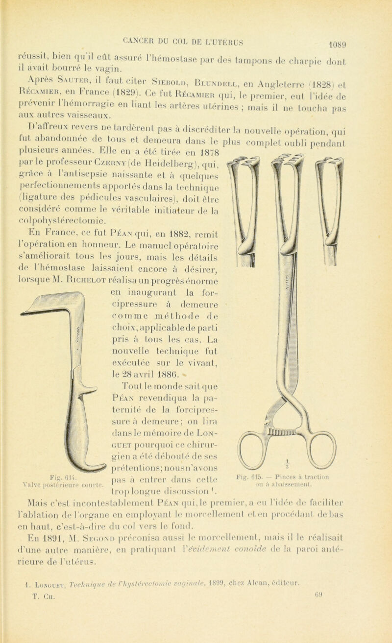 réussit, bien qu il eût assuré l’hémostase par des tampons de charpie dont il avait bourré le vagin. Apres Sauter, il laut citer Sierold, Blundell, en Angleterre M828) et Recamier en France (1829). Ce fut Recamier qui, le premier, eut l’idée de provenir 1 hémorragie en liant les artères utérines ; mais il ne loucha pas aux autres vaisseaux. D'affreux revers ne tardèrent pas à discréditer la nouvelle opération, qui tut abandonnée de tous et demeura dans le plus complet oubli pendant plusieurs années. Elle en a été tirée en 1878 par le professeur Czerny(de Heidelberg), qui. grâce à l’antisepsie naissante et à quelques perfectionnements apportés dans la technique (ligature des pédicules vasculaires), doit être considéré comme le véritable initiateur de la colpohystérectomie. En France, ce fut Péan qui, en 1882, remit l’opération en honneur. Le manuel opératoire s’améliorait tous les jours, mais les détails de l’hémostase laissaient encore à désirer, lorsque M. Richelot réalisa un progrès énorme en inaugurant la for- cipressure à demeure comme méthode de choix, applicable de parti pris à tous les cas. La nouvelle technique fut exécutée sur le vivant, le 28avril 1886. foui le monde sait (jue Péan revendiqua la pa- ternité de la forcipres- sure à demeure; on lira dans le mémoire de Lon- guet pourquoi ce chirur- gien a été déboulé < 1 e ses Fig. 6IL Valve postérieure convie Fig. 615. — Pinces à traction ou à abaissement. prétentions; nous n’avons pas à entrer dans cette Irop longue discussion ’. Mais c’est incontestablement Péan qui,le premier, a eu l’idée de faciliter l’ablation de l'organe eu employant h' morcellement et en procédant de bas en haut, c’est-à-dire du col vers le fond. En 1891, M. Second préconisa aussi le morcellement, mais il le réalisait d’une autre manière, en pratiquant Y évidement conoïde de la paroi anté- rieure de l’utérus. 1. Longuet, Technique de Thystéreclomie vaginale, 1899, chez Alcan, éditeur. T. Ch. 69