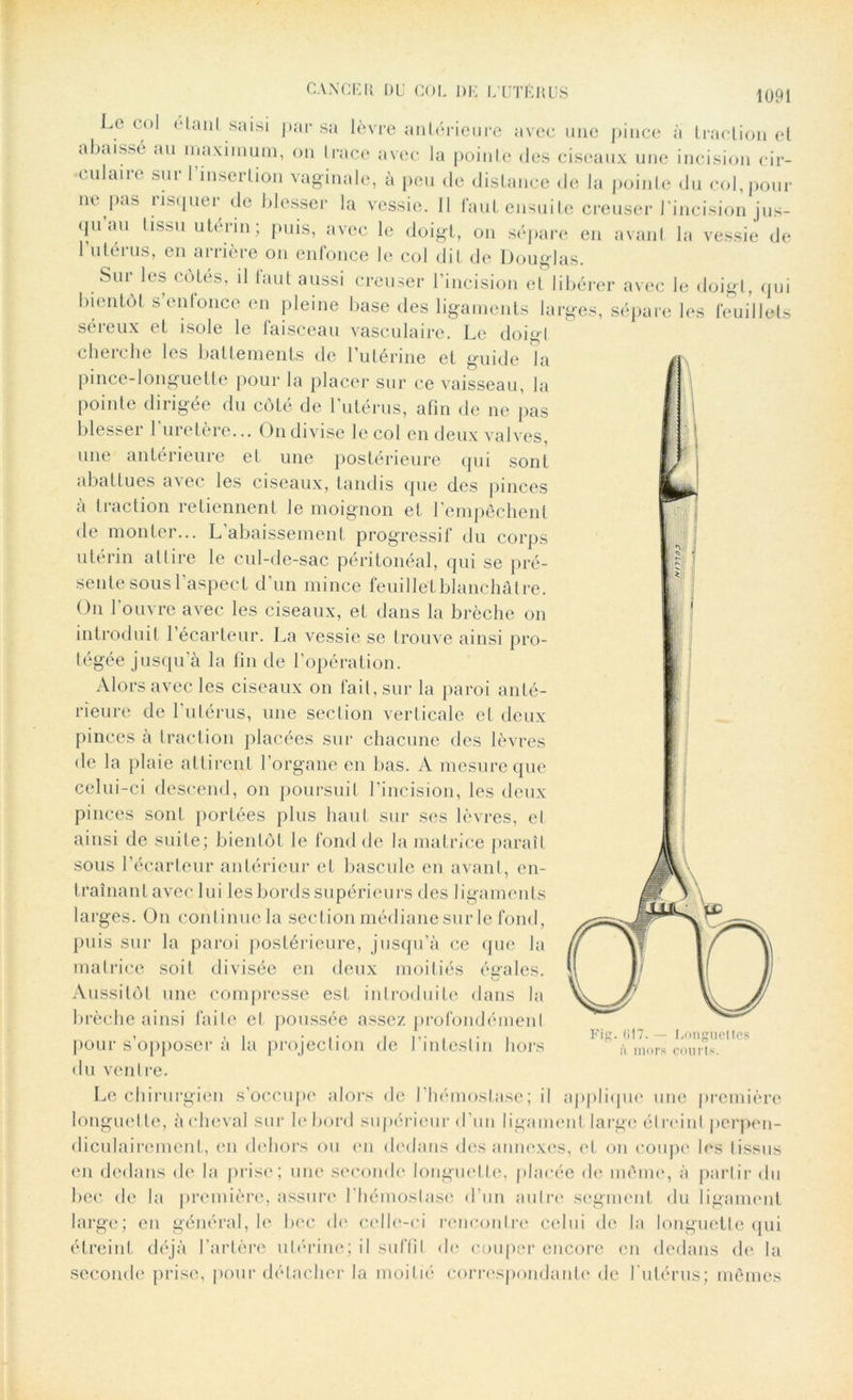 Le C()1 tdanl saisi par sa lèvre antérieure avec une pince à traction et abaissé au maximum, on Irace avec la pointe des ciseaux une incision cir- culaire sur l’insertion vaginale, à peu de distance de la pointe du col, pour nt pas risquer de blesser la vessie. Il faut ensuite creuser l’incision jus- qu’au tissu utérin; puis, avec le doigt, on sépare en avant la vessie de 1 utérus, en arrière on enfonce le col dit de Douglas. Sui les cotés, il faut aussi creuser l’incision et libérer avec le doigt, qui bientôt s’enfonce en pleine base des ligaments larges, sépare les feuillets séreux et isole le faisceau vasculaire. Le doigt cherche les battements de l’utérine et guide la pince-longuette pour la placer sur ce vaisseau, la pointe dirigée du côté de l'utérus, afin de ne pas blesser 1 uretère... On divise le col en deux valves, une antérieure et une postérieure qui sont abattues avec les ciseaux, tandis que des pinces à traction retiennent le moignon et l’empêchent de monter... L’abaissement progressif du corps utérin attire le cul-de-sac péritonéal, qui se pré- sente sous l’aspect d’un mince feuillet blanchâtre. On l’ouvre avec les ciseaux, et dans la brèche on introduit l’écarteur. La vessie se trouve ainsi pro- tégée jusqu’à la fin de l’opération. Alors avec les ciseaux on fait, sur la paroi anté- rieure de l'utérus, une section verticale et deux pinces à traction placées sur chacune des lèvres de la plaie attirent l’organe en bas. A mesure que celui-ci descend, on poursuit l’incision, les deux pinces sont portées plus haut sur ses lèvres, cl ainsi de suite; bientôt le fond de la matrice paraît sous l’écarteur antérieur et bascule en avant, en- traînant avec lui les bords supérieurs des ligaments larges. On continue la section médiane sur le fond, puis sur la paroi postérieure, jusqu’à ce que la matrice soit divisée en deux moitiés égales. Aussitôt une compresse est introduite dans la brèche ainsi faite et poussée assez profondément pour s’opposer à la projection de l'intestin hors du ventre. Le chirurgien s’occupe alors de I’hémoslase; il applique une première longuette, à cheval sur le bord supérieur d’un ligament large étreint perpen- diculairement, en dehors ou en dedans des annexes, et on coupe les tissus en dedans de la prise; une seconde longuette, placée de même, à partir du bec de la première, assure l’hémostase d’un autre segment du ligament large; en général, le bec de celle-ci rencontre celui de la longuette qui étreint déjà l’artère utérine; il suffît de couper encore en dedans de la seconde prise, pour détacher la moitié correspondante de l’utérus; mêmes Fig. 017. — Longuettes à mors courts.