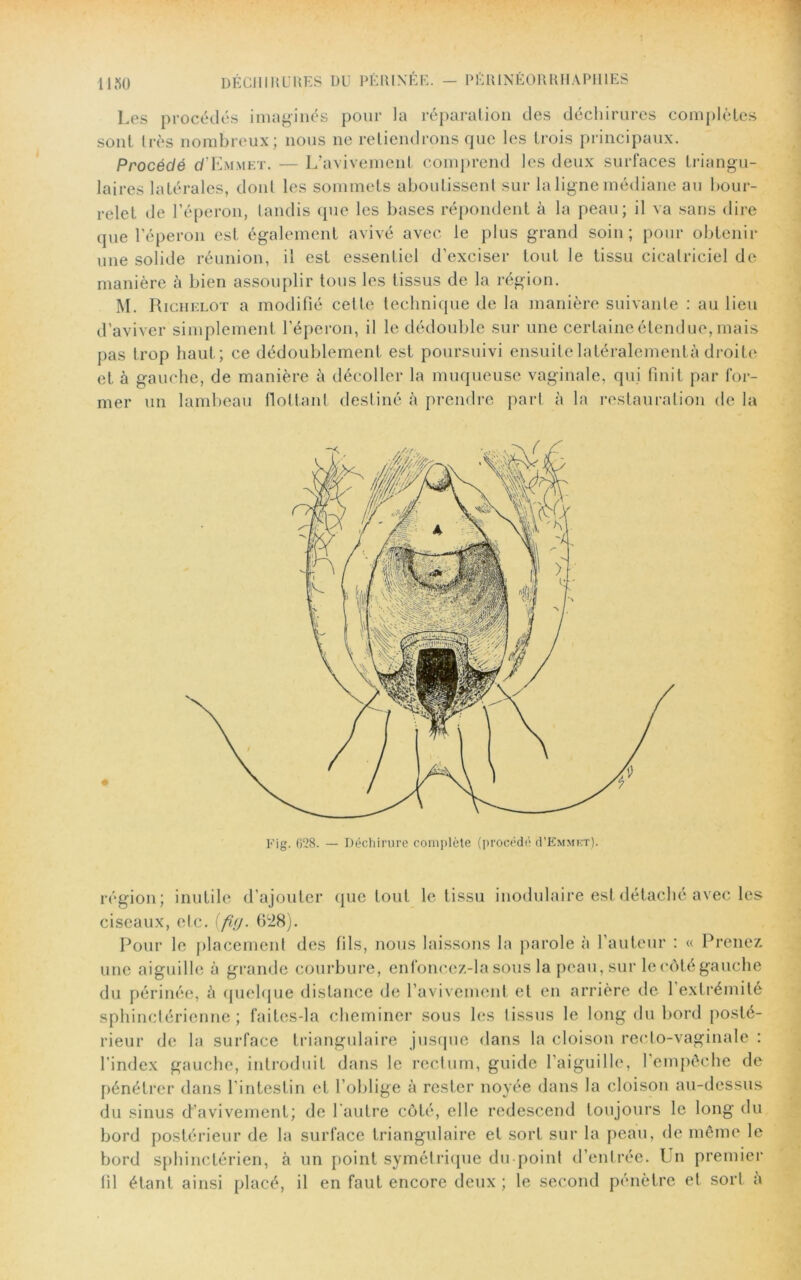 Les procédés imaginés pour la réparation des déchirures complètes sont très nombreux; nous ne retiendrons que les trois principaux. Procédé d'Emmet. — L’avivement comprend les deux surfaces triangu- laires latérales, dont les sommets aboutissent sur la ligne médiane au bour- relet de l’éperon, tandis que les bases répondent à la peau; il va sans dire que l’éperon est également avivé avec le plus grand soin; pour obtenir une solide réunion, il est essentiel d’exciser tout le tissu cicatriciel de manière à bien assouplir tous les tissus de la région. M. Richelot a modifié celte technique de la manière suivante : au lieu d’aviver simplement l’éperon, il le dédouble sur une certaine étendue, mais pas trop haut; ce dédoublement est poursuivi ensuitelatéralcmcntà droite et à gauche, de manière à décoller la muqueuse vaginale, qui finit par for- mer un lambeau flottant destiné à prendre part à la restauration de la Fig. 628. — Déchirure complète (procédé (I’Emmkt). région; inutile d’ajouter que tout le tissu modulaire est détaché avec les ciseaux, etc. (fig. 628). Pour le placement des fils, nous laissons la parole à l’auteur : « Prenez une aiguille à grande courbure, enfoneez-la sous la peau, sur le côté gauche du périnée, à quelque distance de l’avivement et en arrière de 1 extrémité sphinctérienne; faites-la cheminer sous les tissus le long du bord posté- rieur de la surface triangulaire jusque dans la cloison recto-vaginale : l’index gauche, introduit dans le rectum, guide l’aiguille, l’empêche de pénétrer dans l’intestin et l’oblige à rester noyée dans la cloison au-dessus du sinus d’avivement; de l'autre côté, elle redescend toujours le long du bord postérieur de la surface triangulaire et sort sur la peau, de même le bord sphinctérien, à un point symétrique du point d’entrée. Un premier fil étant ainsi placé, il en faut encore deux ; le second pénètre et sorl a