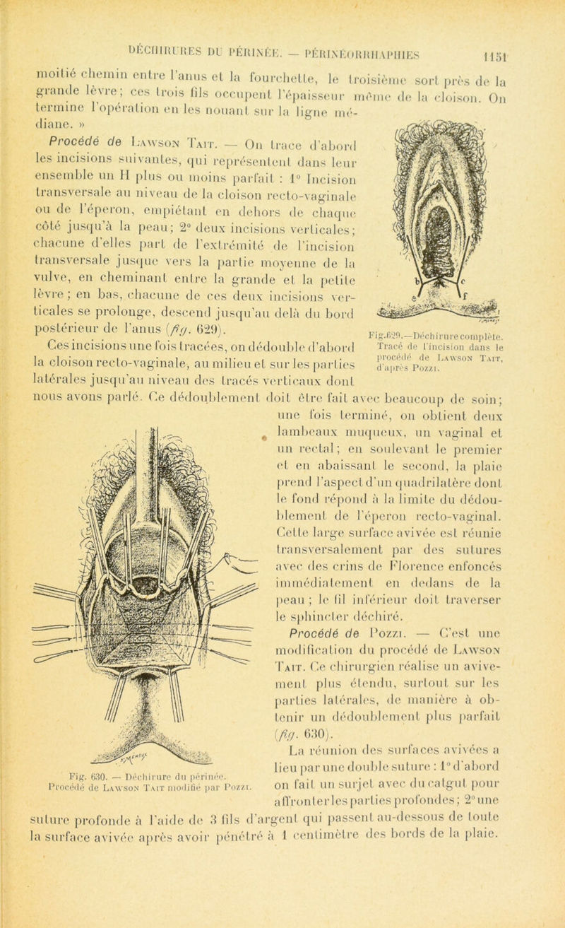 W *•* Fi g.fi2fl.—Déc h i ru re coin plète. Tracé de l'incision dans le procédé de Lawson Tait, d'après Pozzi. DÉCHIRURES DU PÉRINÉE. — PÉRINÉORRHAPIllËS 1151 1110,110 chemin entre l’anus et la fourchette, le troisième sort près de la grande levre; ces trois fils occupent l’épaisseur même de la cloison. On teimine 1 opération en les nouant sur la ligne mé- diane. » Procédé de Lawson Tait. — On trace d’abord les incisions suivantes, qui représentent dans leur ensemble un 11 plus ou moins parfait : 1° Incision tiansvei sale au niveau de la cloison recto-vaginale ou de 1 eperon, empiétant en dehors de chaque côté jusqu à la peau; 2° deux incisions verticales; chacune d elles part de l’extrémité de l’incision transversale jusque vers la partie moyenne de la vulve, en cheminant entre la grande et la petite lèvre ; en bas, chacune de ces deux incisions ver- ticales se prolonge, descend jusqu’au delà du bord postérieur de l’anus [fig. 629). Ces incisions une fois tracées, on dédouble d’abord la cloison recto-vaginale, au milieu et sur les parties latérales jusqu’au niveau des tracés verticaux dont nous avons parlé. Ce dédoublement doit être fait avec beaucoup de soin; une fois terminé, on obtient deux lambeaux muqueux, un vaginal et un rectal; en soulevant le premier et en abaissant le second, la plaie prend l’aspect d’un quadrilatère dont le fond répond à la limite du dédou- blement de l’éperon recto-vaginal. Cette large surface avivée est réunie transversalement par des sutures avec des crins de Florence enfoncés immédiatement en dedans de la peau ; le fil inférieur doit traverser le sphincter déchiré. Procédé de Pozzi. — C’est une modification du procédé de Lawson Tait. Ce chirurgien réalise un avive- ment plus étendu, surtout sur les parties latérales, de manière à ob- tenir un dédoublement plus parfait [firj- 630). La réunion des surfaces avivées a lieu par une double suture : l°d abord on fait un surjet avec du catgut pour affronter les parties profondes ; 2° une Fig. 630. — Déchirure du périnée. Procédé de Lawson Tait modifié par Pozzi. Ulll VMiiv/A IVW ; — suture profonde à l’aide de 3 fils d’argent qui liassent au-dessous de toute la surface avivée après avoir pénétré à 1 centimètre des bords de la plaie.