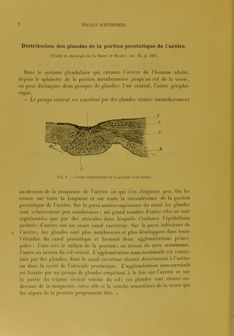 <? Distribution des glandes de la portion prostatique de l'urètre. (Traité de chirurgie de Le Dentc et Delbet, vol. IX, p. 526). Dans le système glandulaire qui entoure l’iirèlre de l’homme adulte, depuis le sphincter de la portion membraneuse jusqu’au col de la vessie, on peut distinguer deux groupes de glandes: l’un central, l’autre périphé- rique. « Le groupe central est constitué par des glandes situées immédiatement Fig. 1. — Coupe longitudinale de la prostate d'un enfant. au-dessous de la muqueuse de l’urètre ou qui s’en éloignenL peu. On les trouve sur toute la longueur et sur toute la circonférence de la portion prostatique de l’urètre. Sur la paroi antéro-supérieure du canal les glandes sont relativement peu nombreuses; un grand nombre d’entre elles ne sont représentées que par des utricules dans lesquels s’enfonce l'épithélium urétral; d’autres ont un court canal excréteur. Sur la paroi inférieure de l'urètre, les glandes sont plus nombreuses et plus développées dans toute l’étendue du canal prostatique et forment deux agglomérations princi- pales: l’une vers le milieu de la prostate, au niveau du vent montanum, l’autre au niveau du col vésical. L’agglomération sous-montanale est consti- tuée par des glandes, dont le canal excréteur aboutit directement à 1 urètre ou dans la cavité de l’utricule prostatique. L'agglomération sous-cervicale est formée par un groupe de glandes empiétant à la fois sur l’urètre et sur la partie du trigono vésical voisine du col; ces glandes sont situées au- dessous de la muqueuse, entre elle et la couche musculaire de la vessie qui les sépare de la prostate proprement dite. »